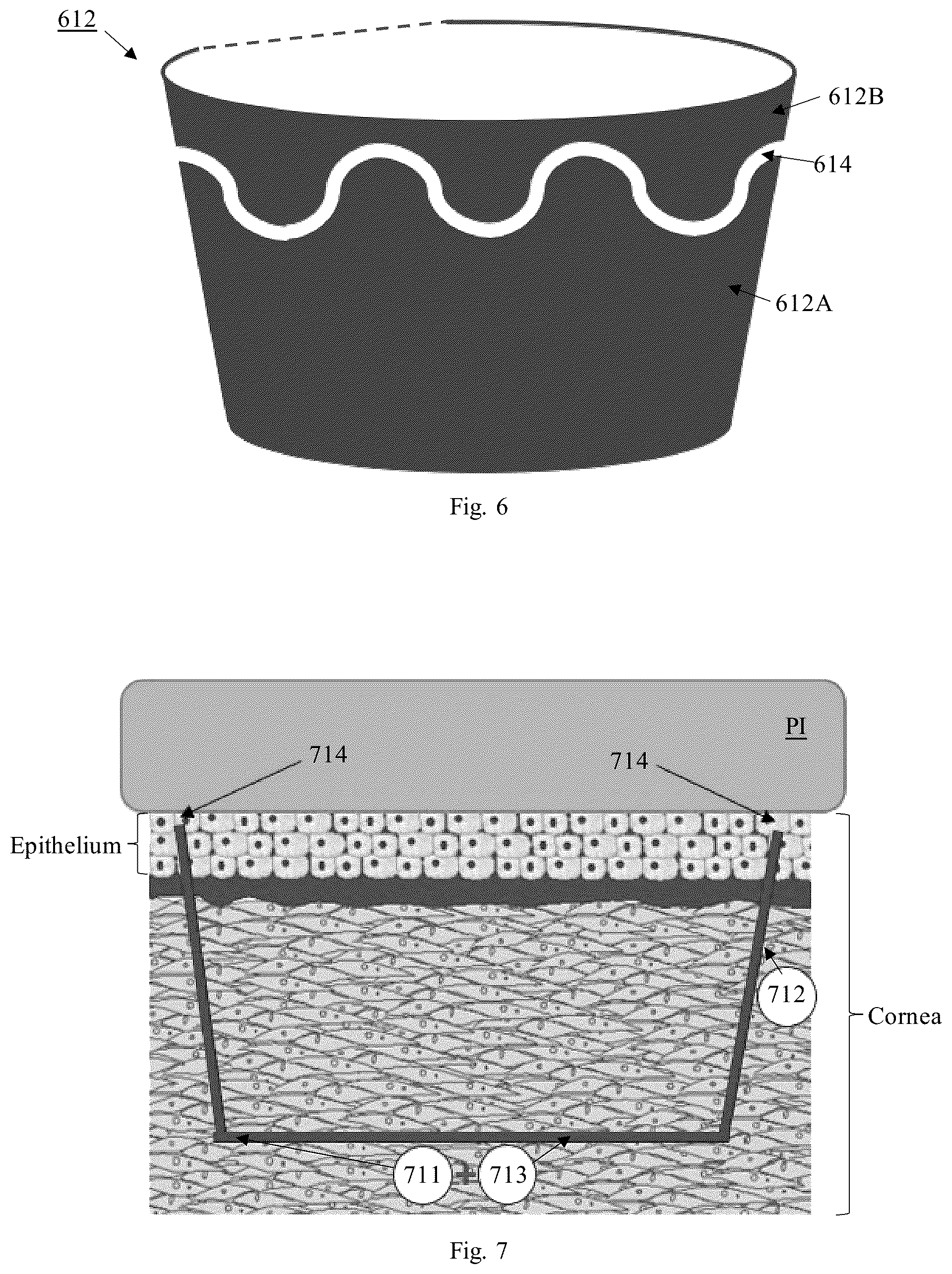 Patent US12310895 Figure 5 – Lasik flap cutting patterns including bubble barrier layer in side cut for bubble management
