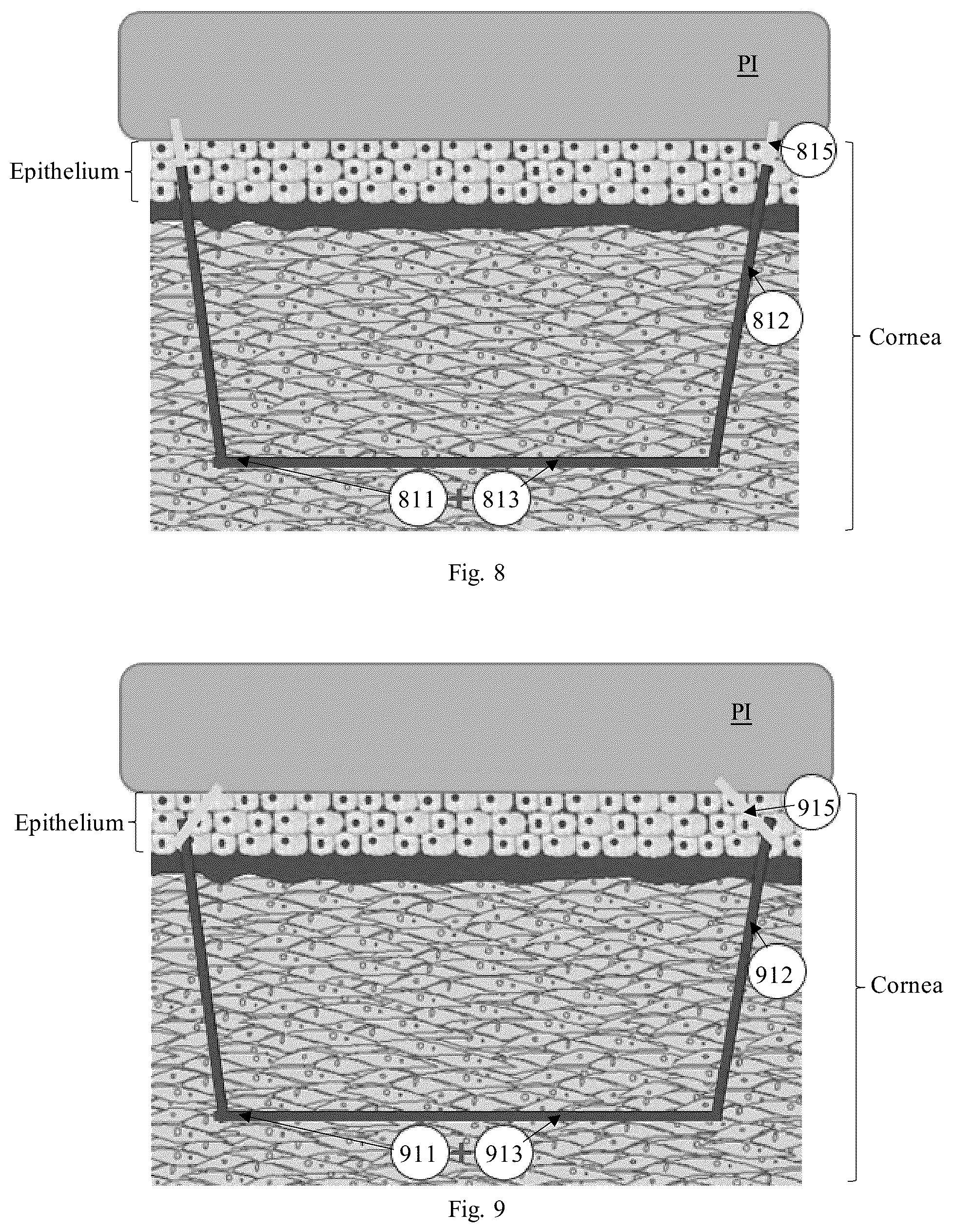 Patent US12310895 Figure 6 – Lasik flap cutting patterns including bubble barrier layer in side cut for bubble management