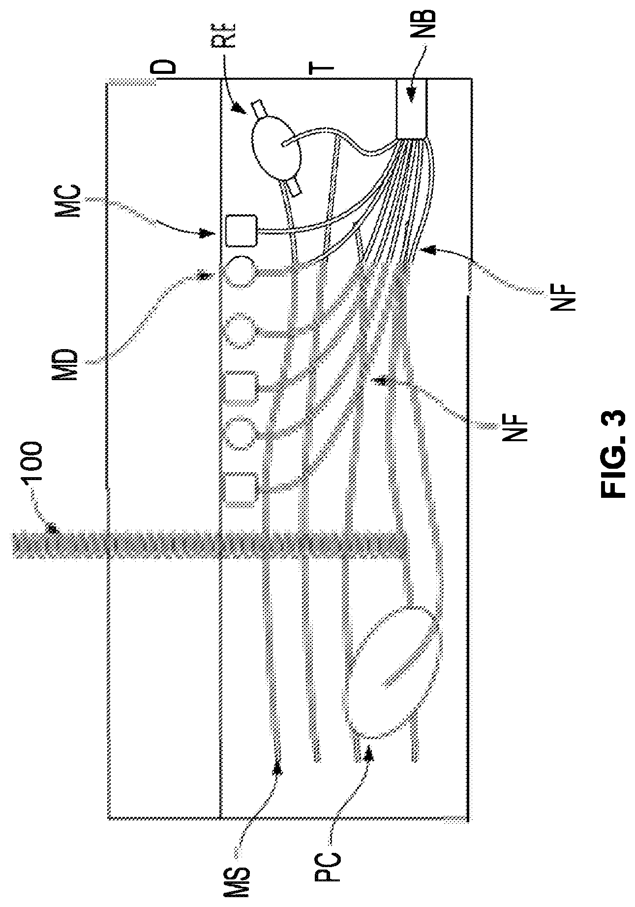 Patent US12310914 Figure 3 – Method and system of mechanical nerve stimulation for pain relief