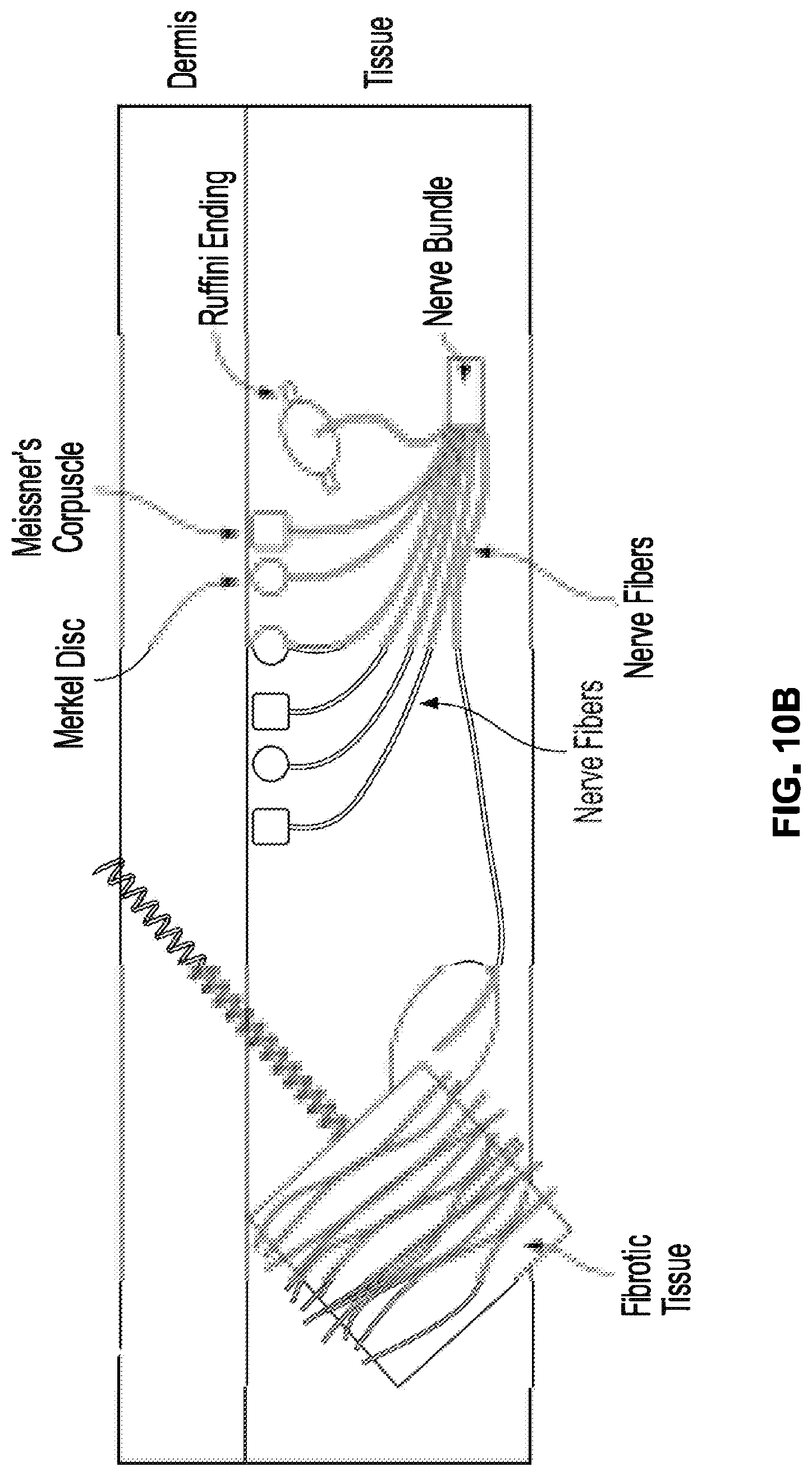 Patent US12310914 Figure 10 – Method and system of mechanical nerve stimulation for pain relief