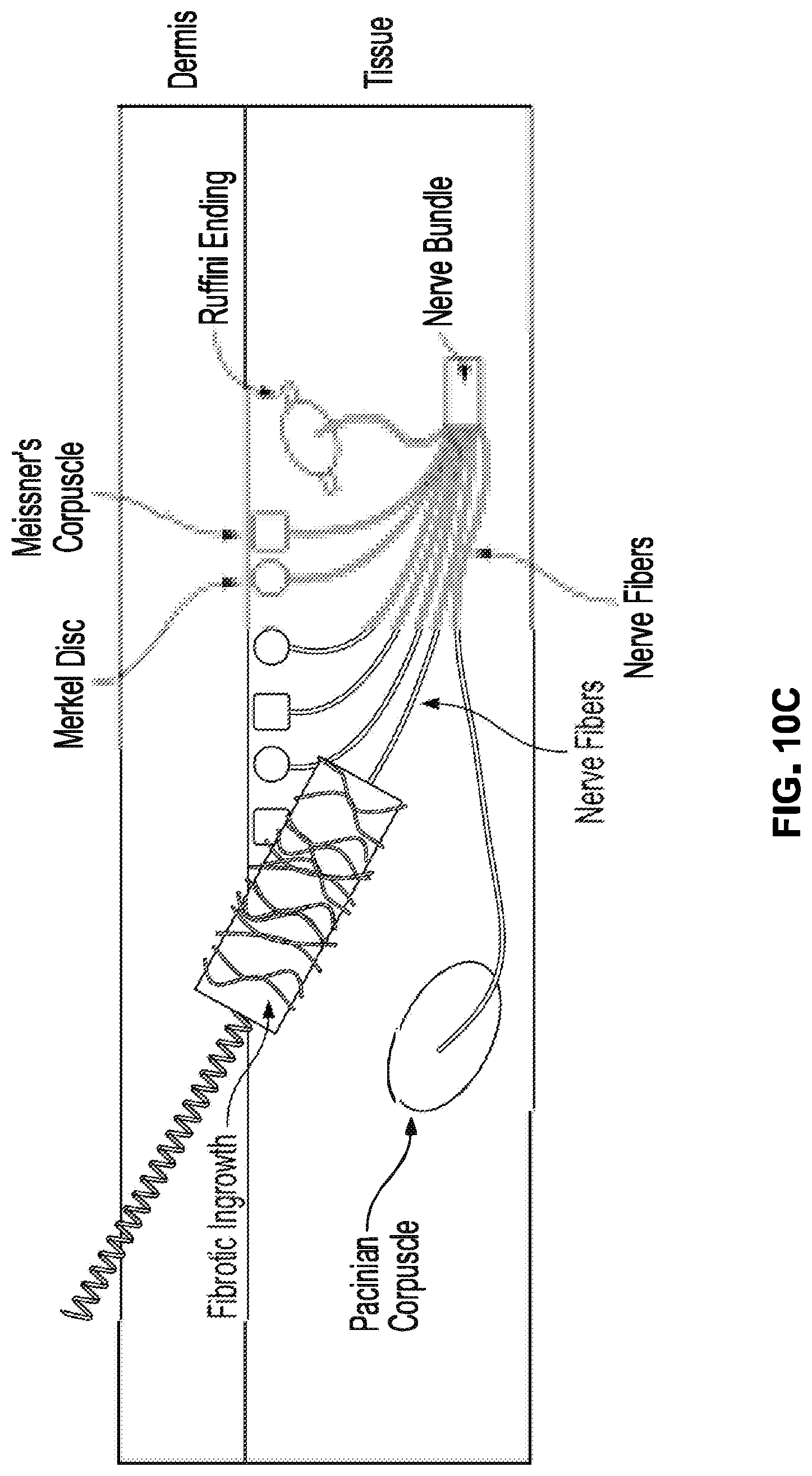 Patent US12310914 Figure 11 – Method and system of mechanical nerve stimulation for pain relief
