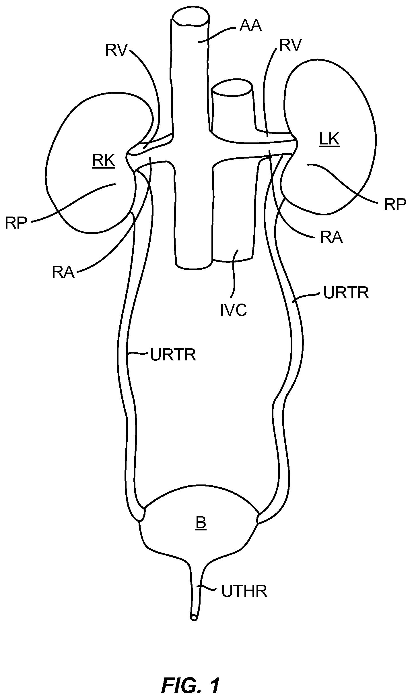 Patent US12310927 Figure 1 – Methods and systems for ablation of the renal pelvis