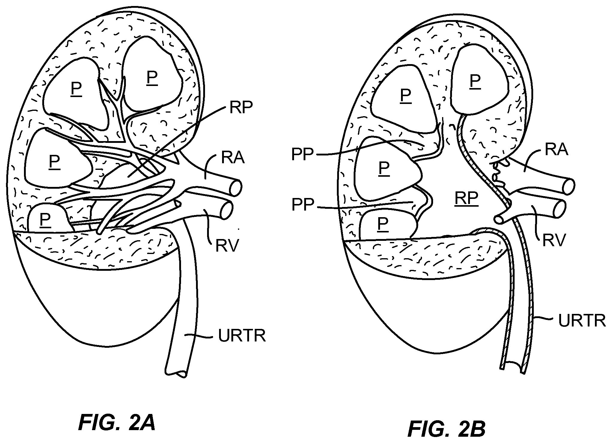 Patent US12310927 Figure 2 – Methods and systems for ablation of the renal pelvis