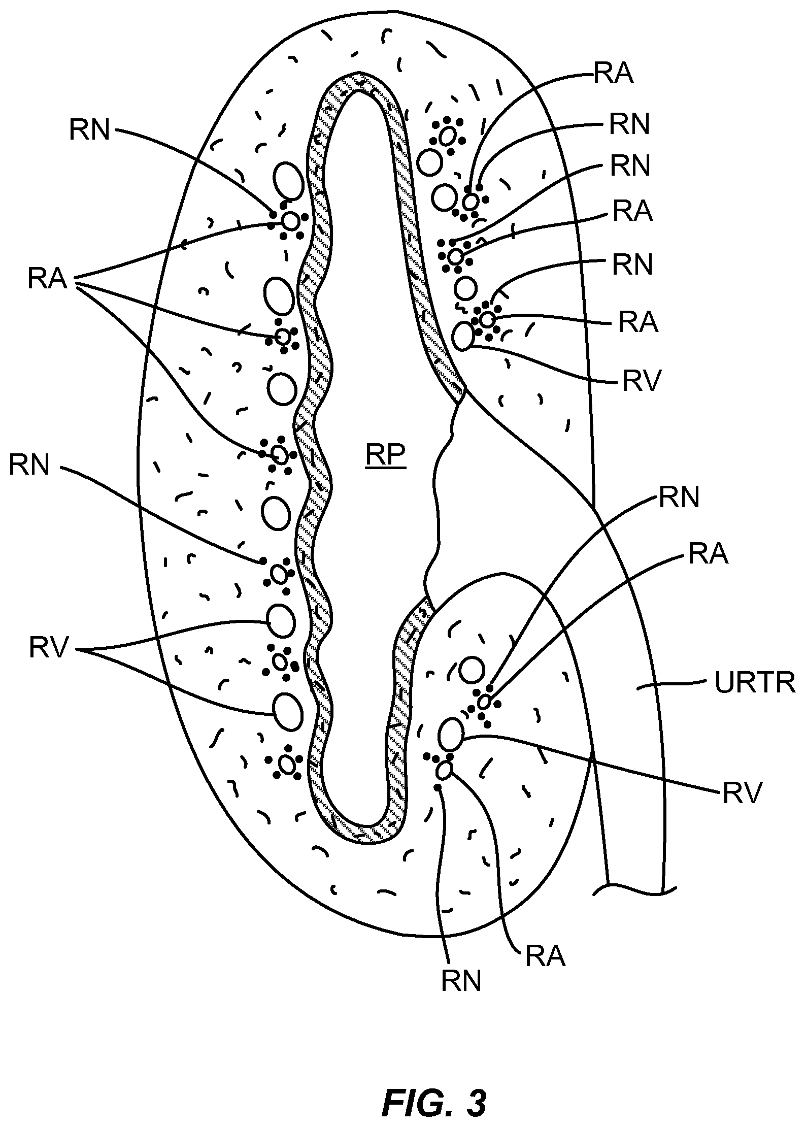 Patent US12310927 Figure 3 – Methods and systems for ablation of the renal pelvis