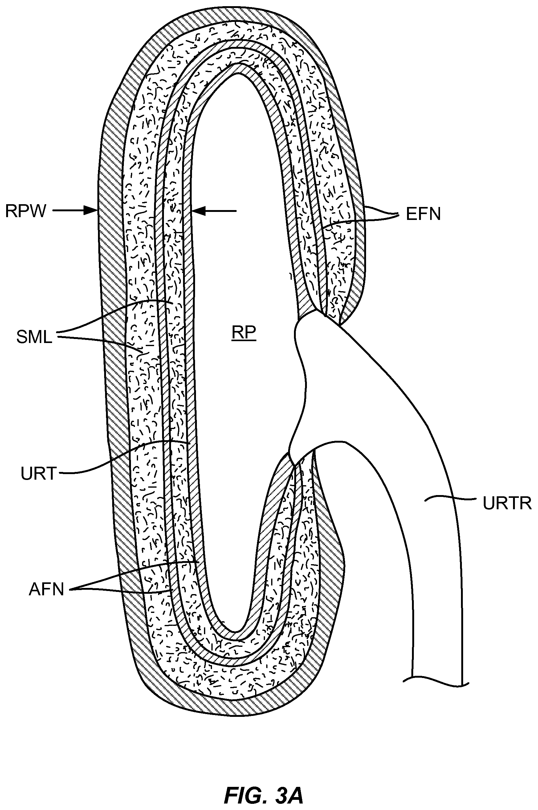 Patent US12310927 Figure 4 – Methods and systems for ablation of the renal pelvis