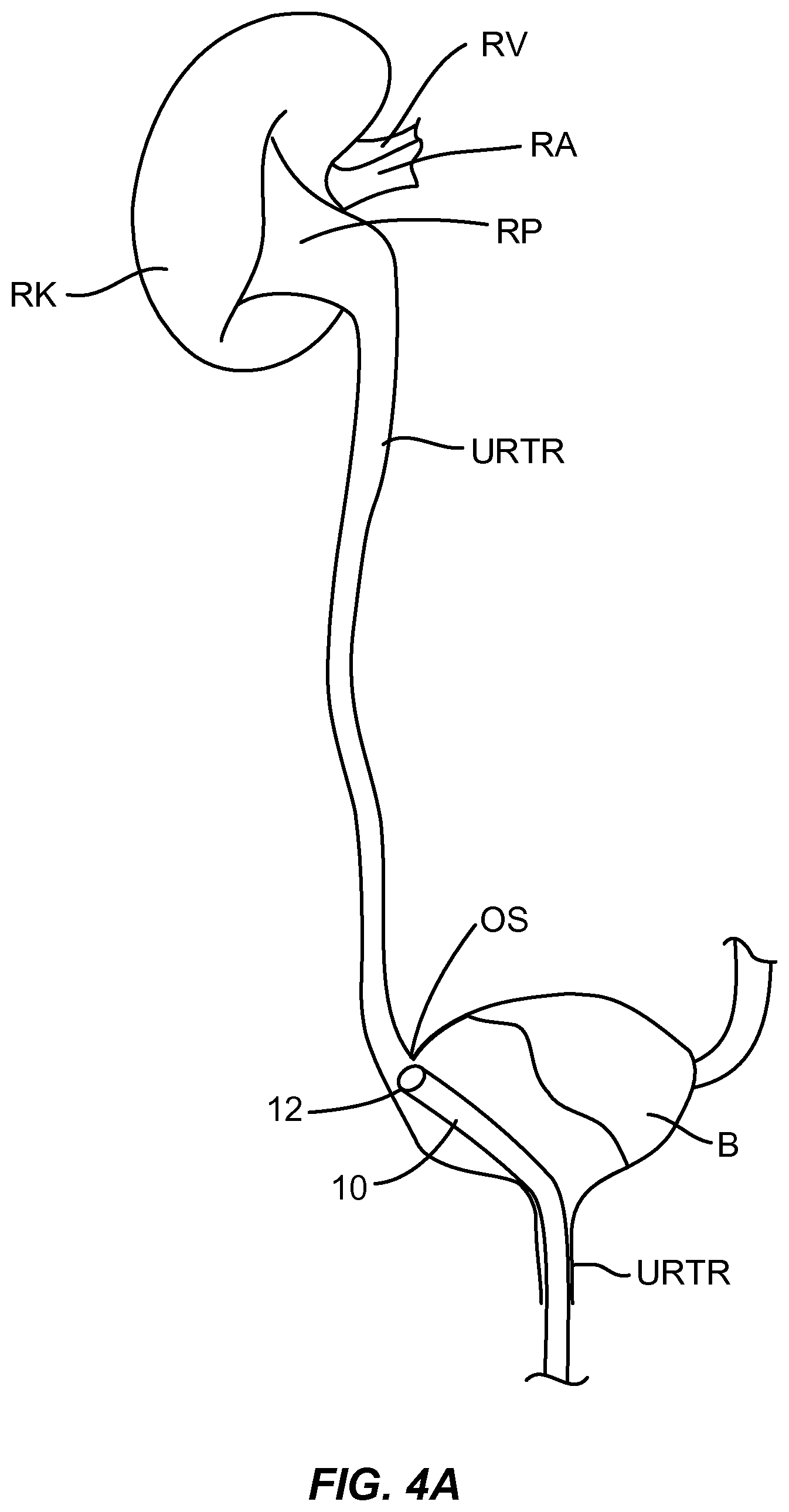 Patent US12310927 Figure 5 – Methods and systems for ablation of the renal pelvis