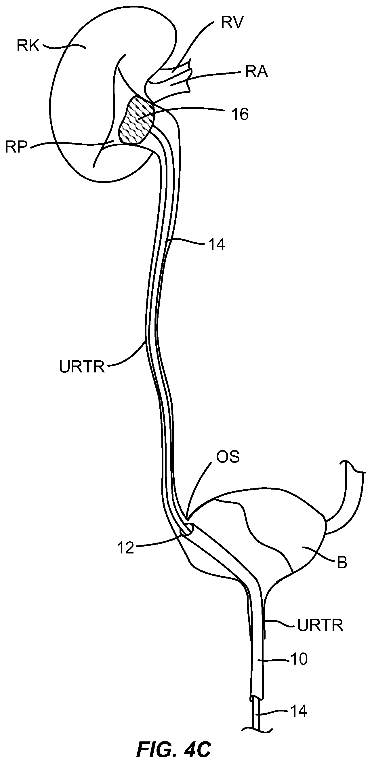 Patent US12310927 Figure 7 – Methods and systems for ablation of the renal pelvis