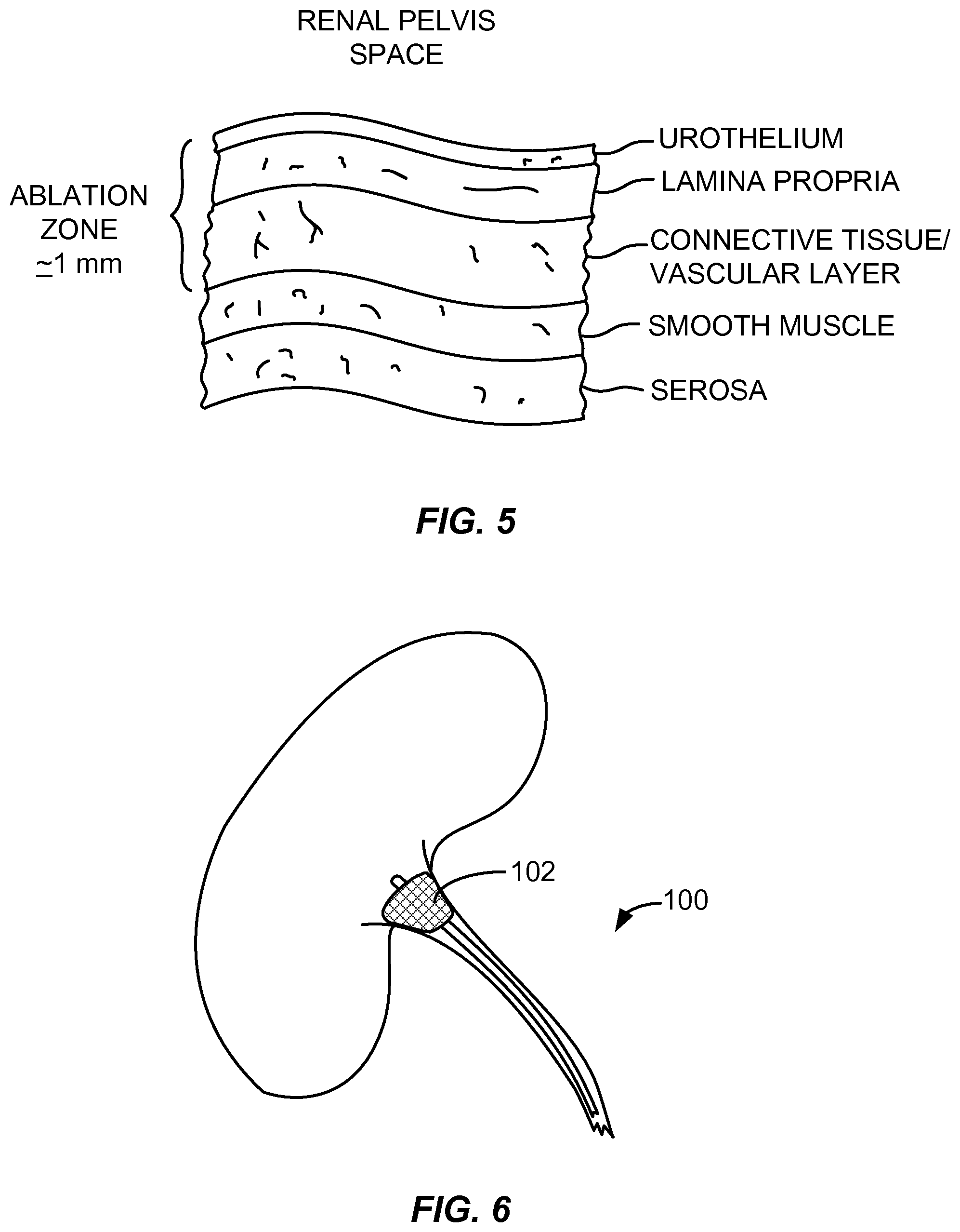 Patent US12310927 Figure 8 – Methods and systems for ablation of the renal pelvis