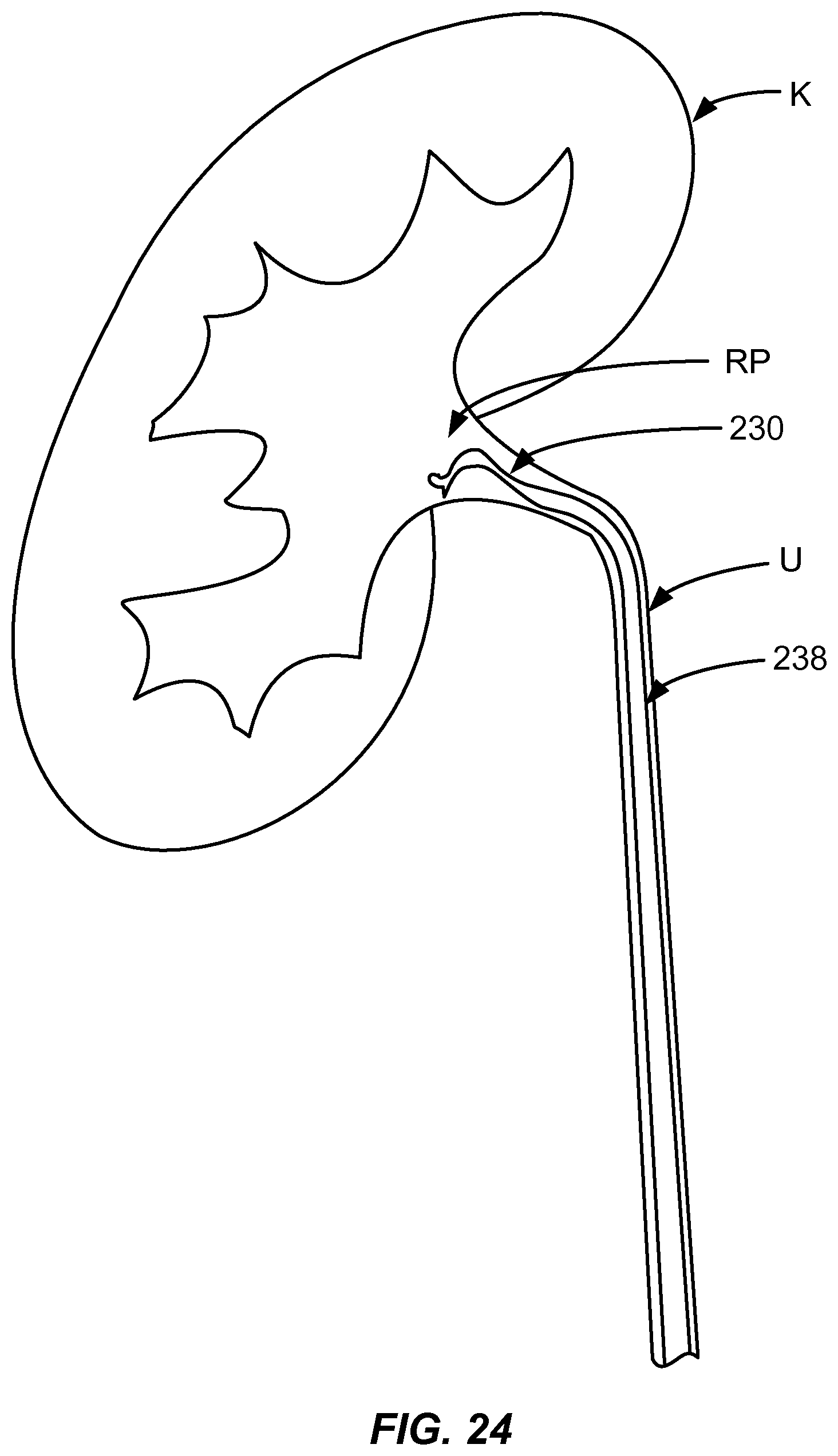 Patent US12310927 Figure 17 – Methods and systems for ablation of the renal pelvis