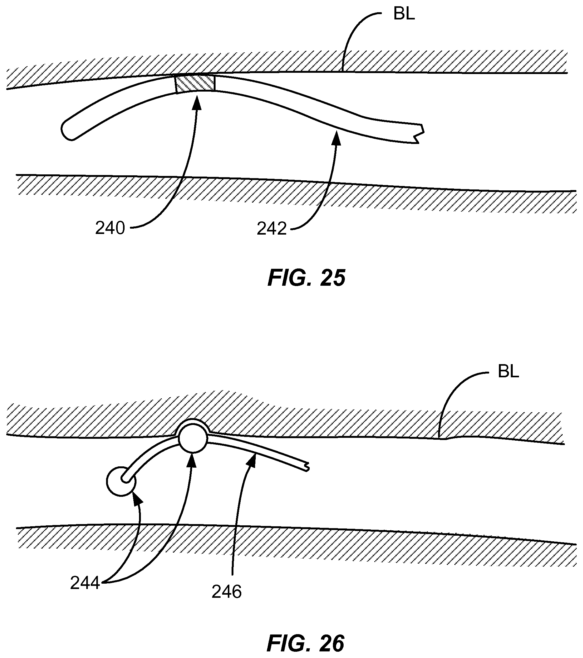 Patent US12310927 Figure 18 – Methods and systems for ablation of the renal pelvis