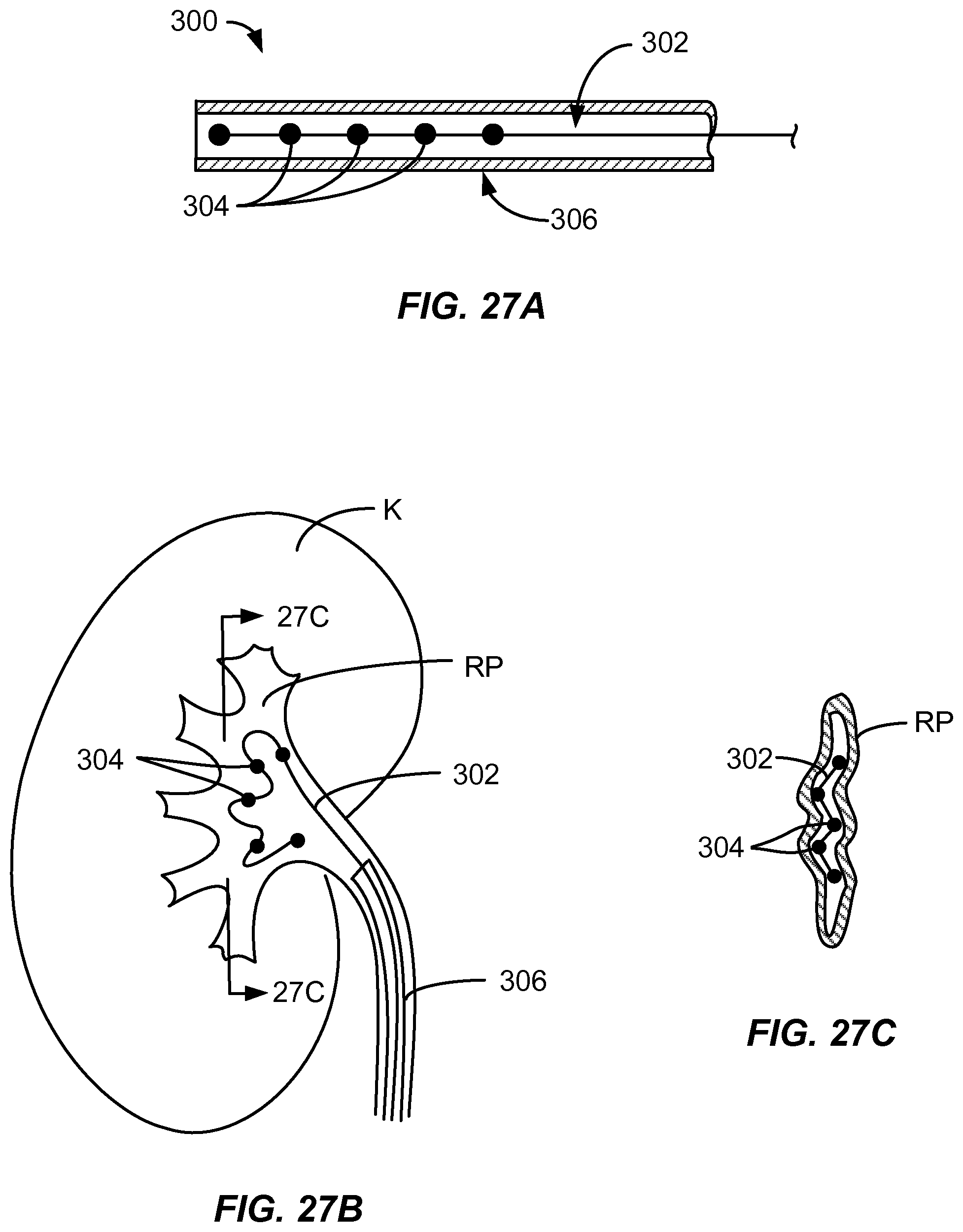 Patent US12310927 Figure 19 – Methods and systems for ablation of the renal pelvis