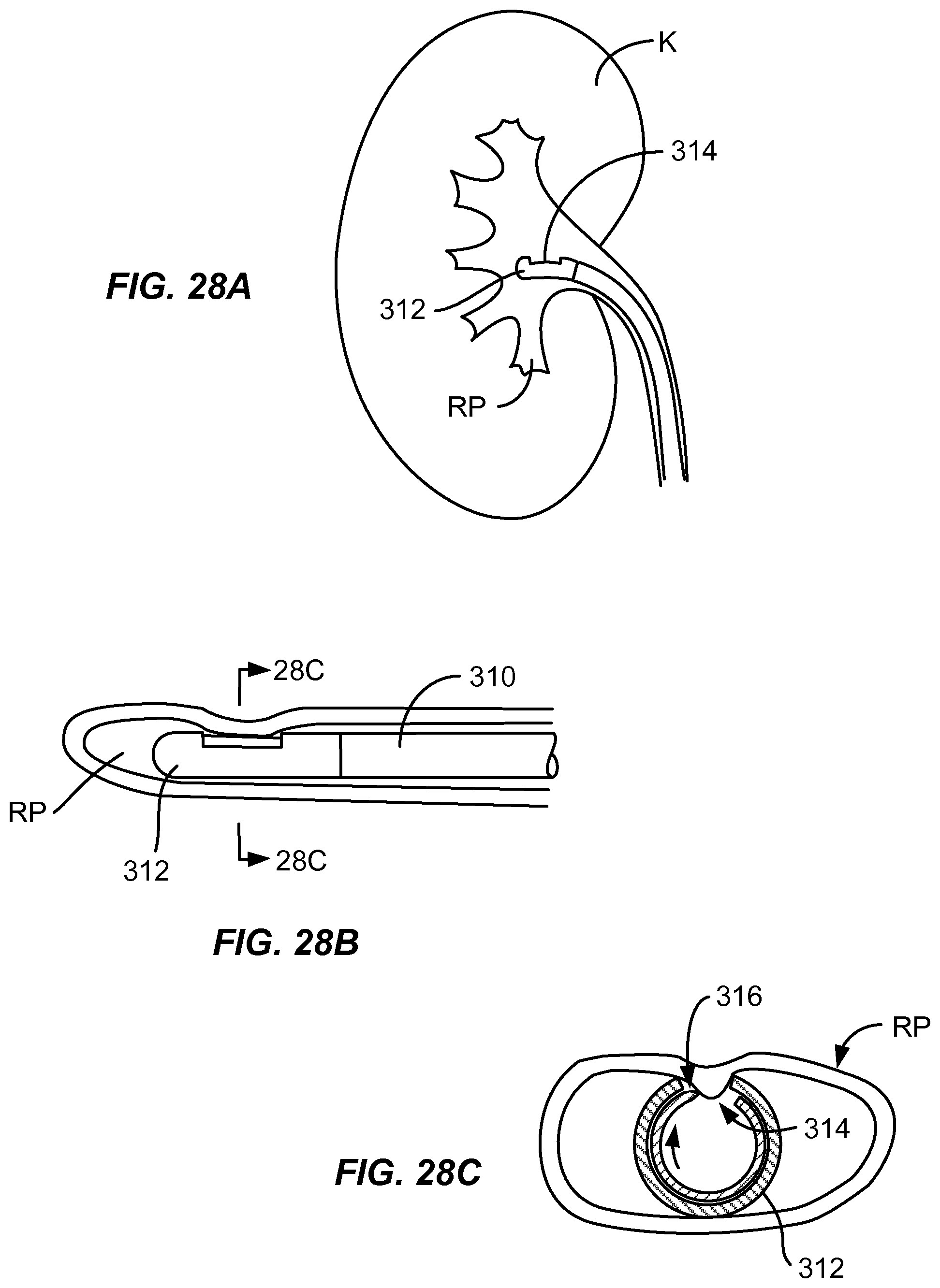 Patent US12310927 Figure 20 – Methods and systems for ablation of the renal pelvis