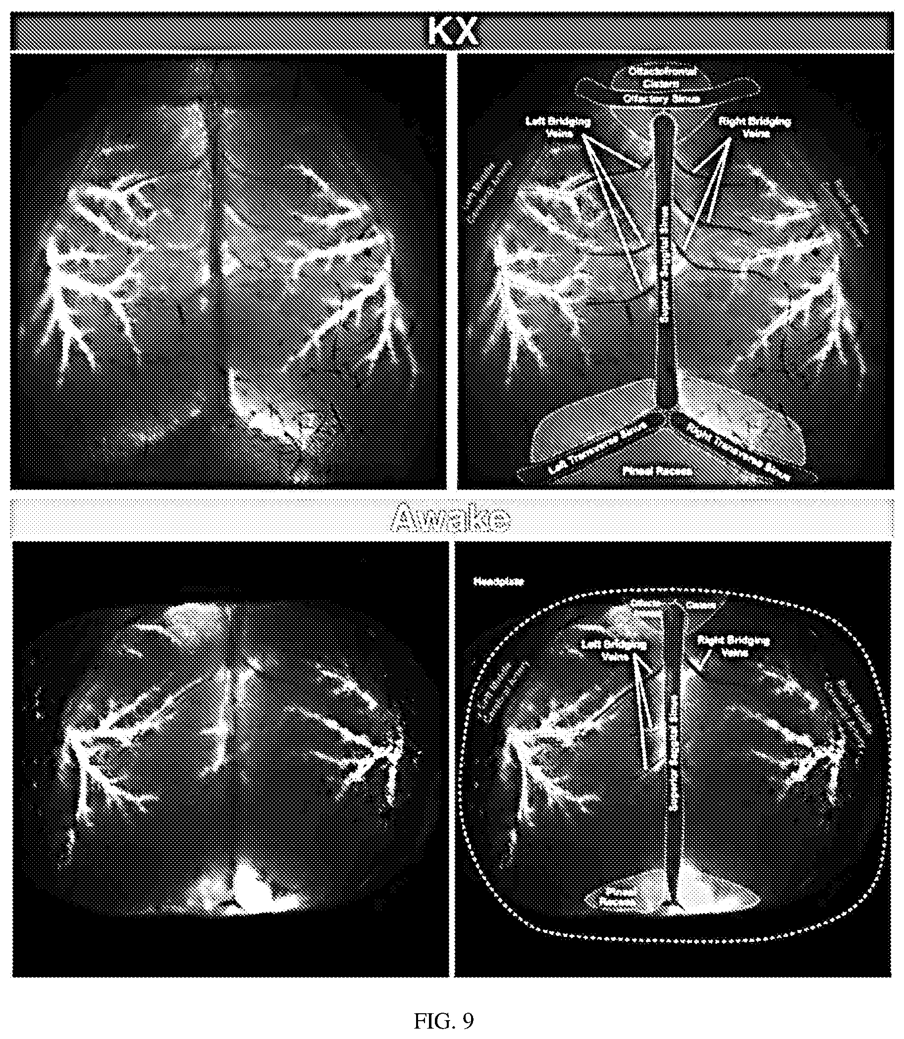 Patent US12311035 Figure 13 – Glymphatic delivery by manipulating plasma osmolarity