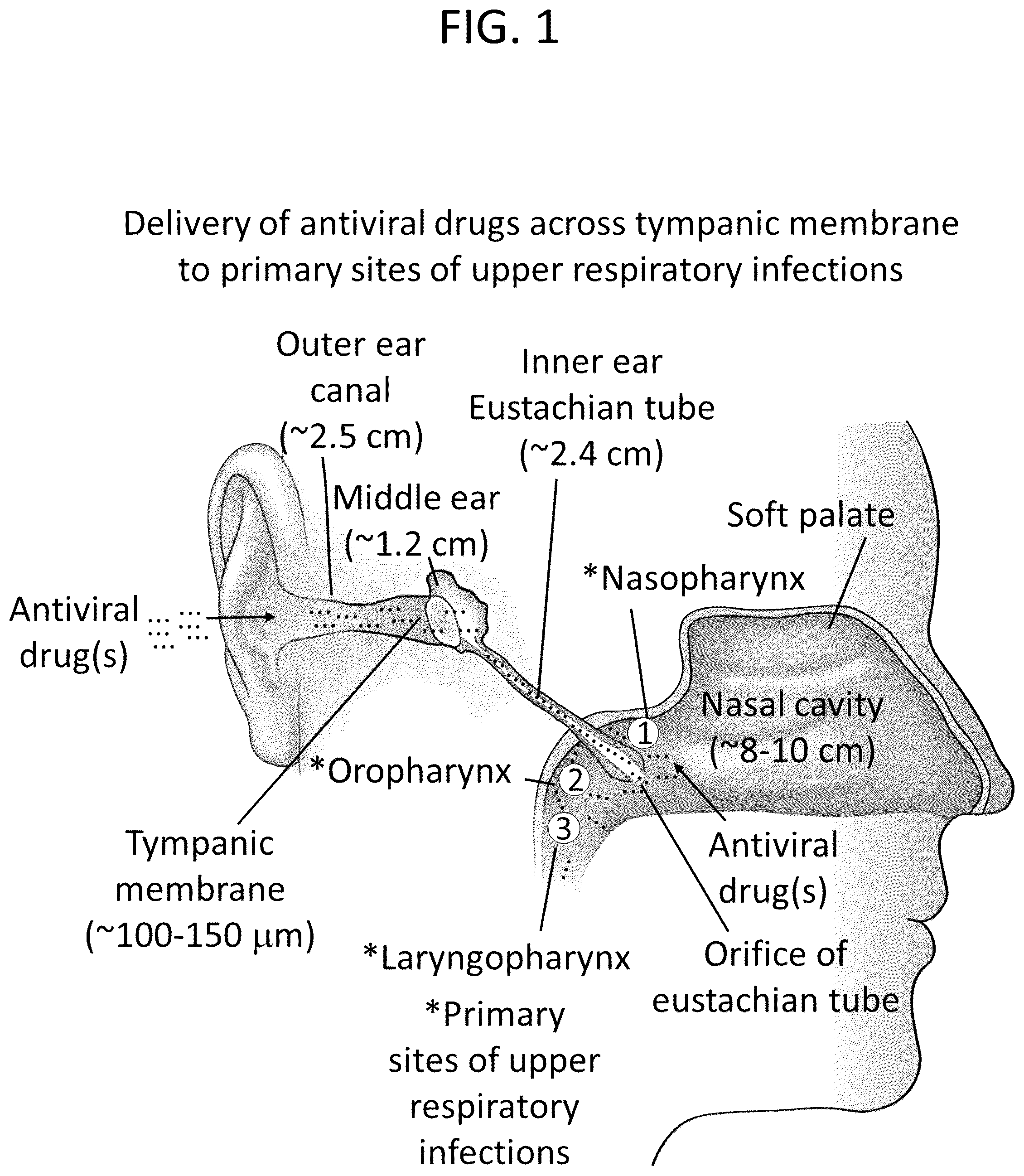 Patent US12311049 — Formulation of ear drops and methods for delivery thereof for treating upper respiratory infections — Figure 1
