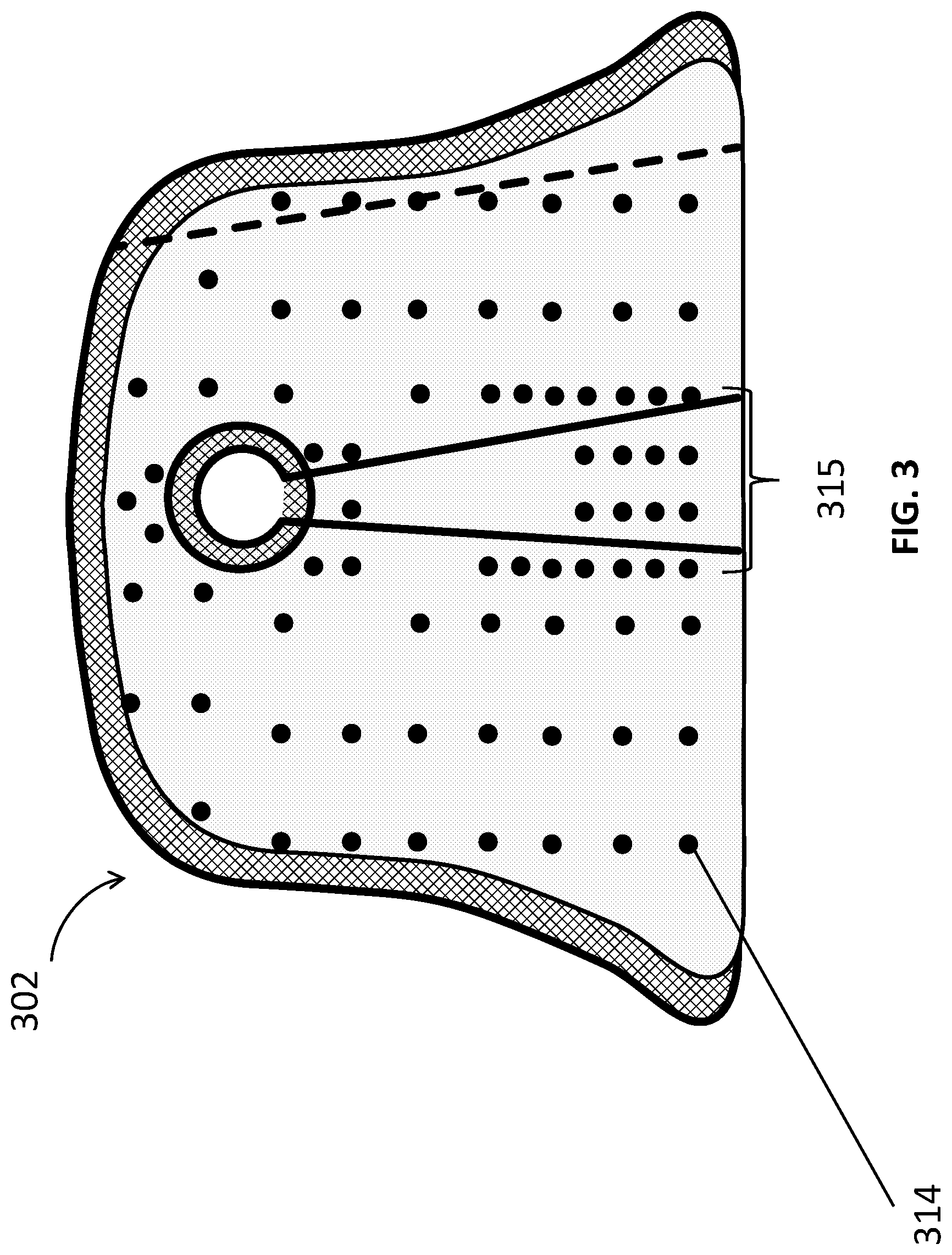 Patent US12311062 Figure 4 – Expanding foam-fabric orthopedic limb stabilization device