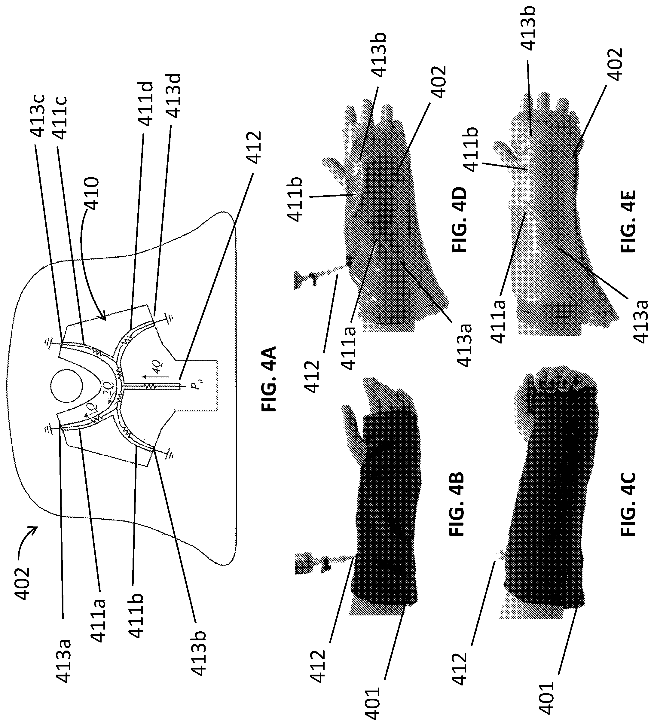 Patent US12311062 Figure 5 – Expanding foam-fabric orthopedic limb stabilization device