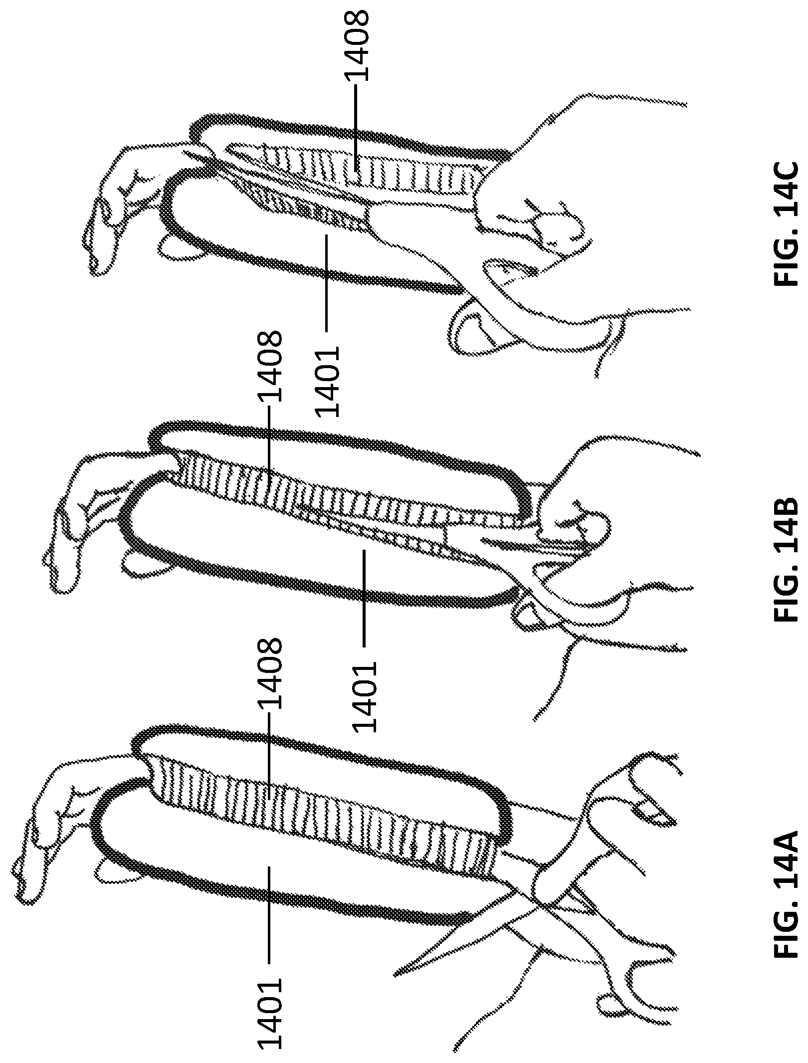 Patent US12311062 Figure 15 – Expanding foam-fabric orthopedic limb stabilization device