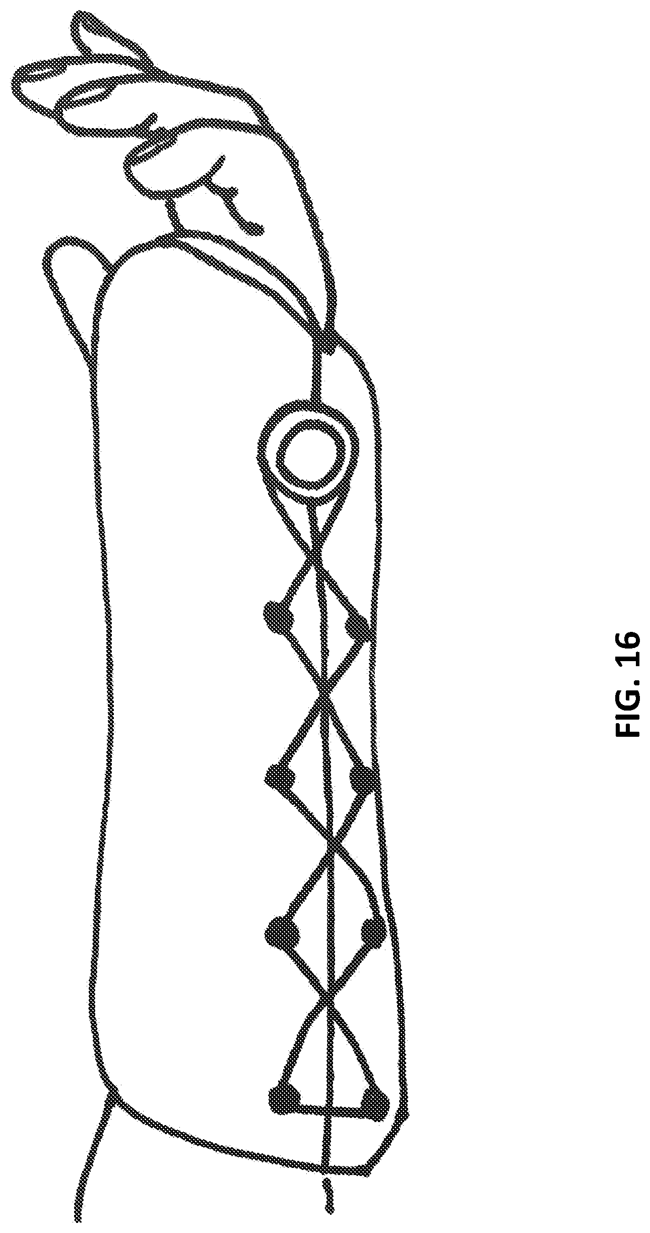 Patent US12311062 Figure 17 – Expanding foam-fabric orthopedic limb stabilization device
