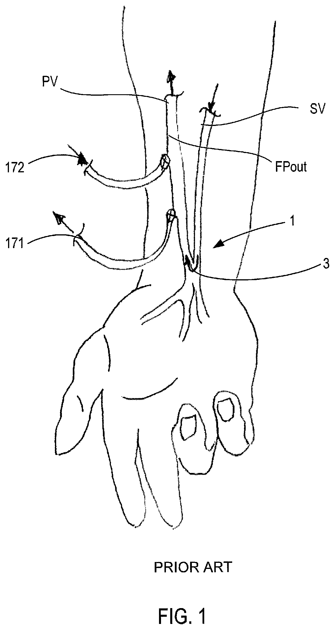 Patent US12311092 Figure 1 – Vascular flow control devices and methods