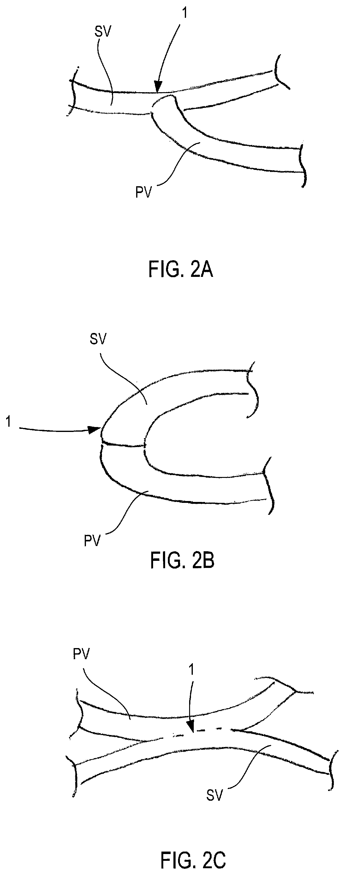 Patent US12311092 Figure 2 – Vascular flow control devices and methods