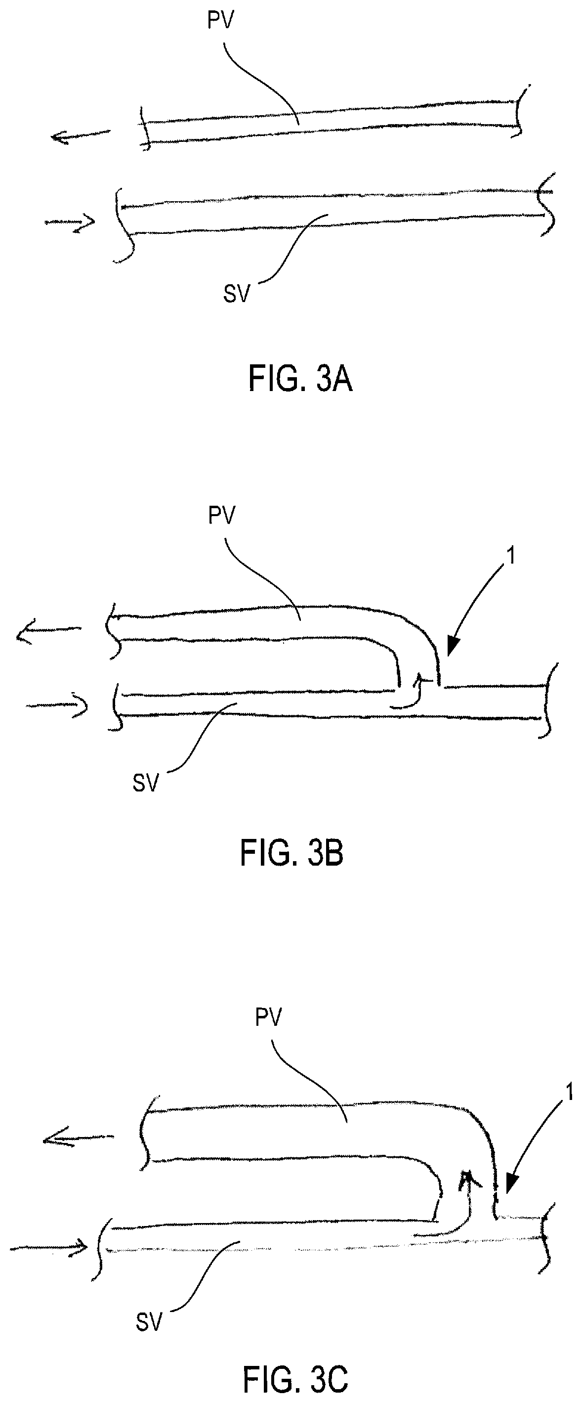 Patent US12311092 Figure 3 – Vascular flow control devices and methods