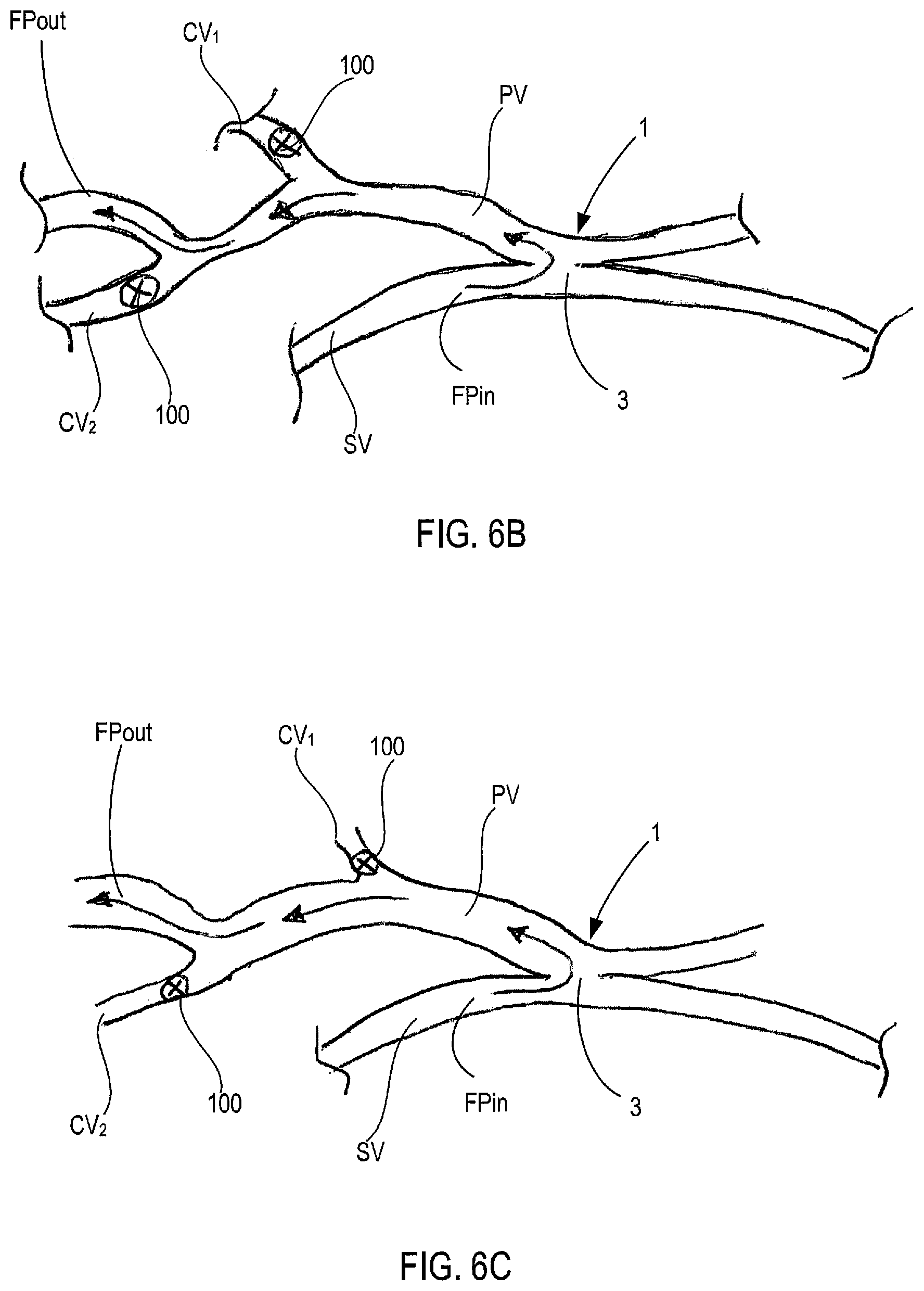 Patent US12311092 Figure 6 – Vascular flow control devices and methods