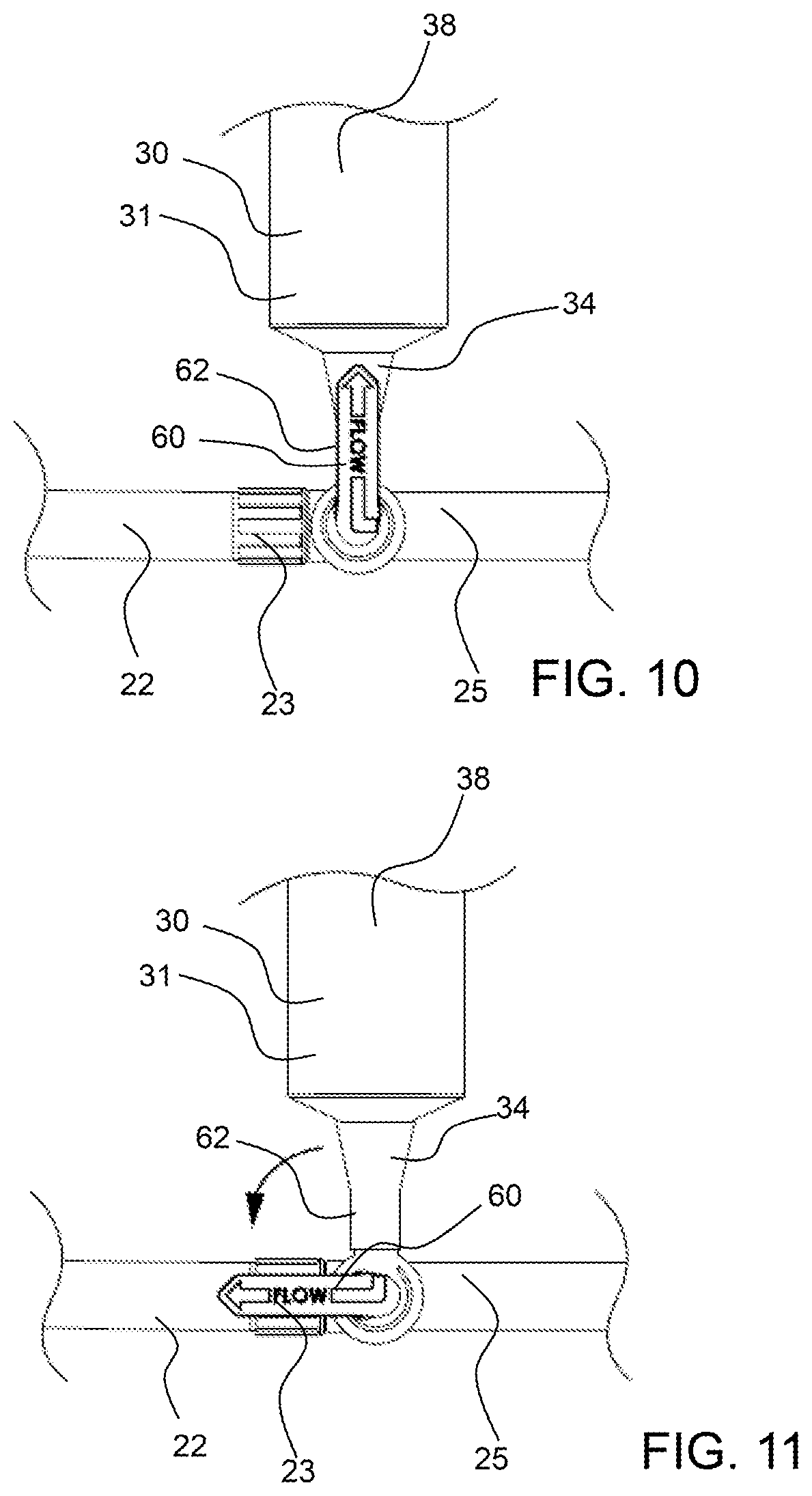 Patent US12311093 Figure 10 – Manual clot aspiration and filtration system and method of removing a clot