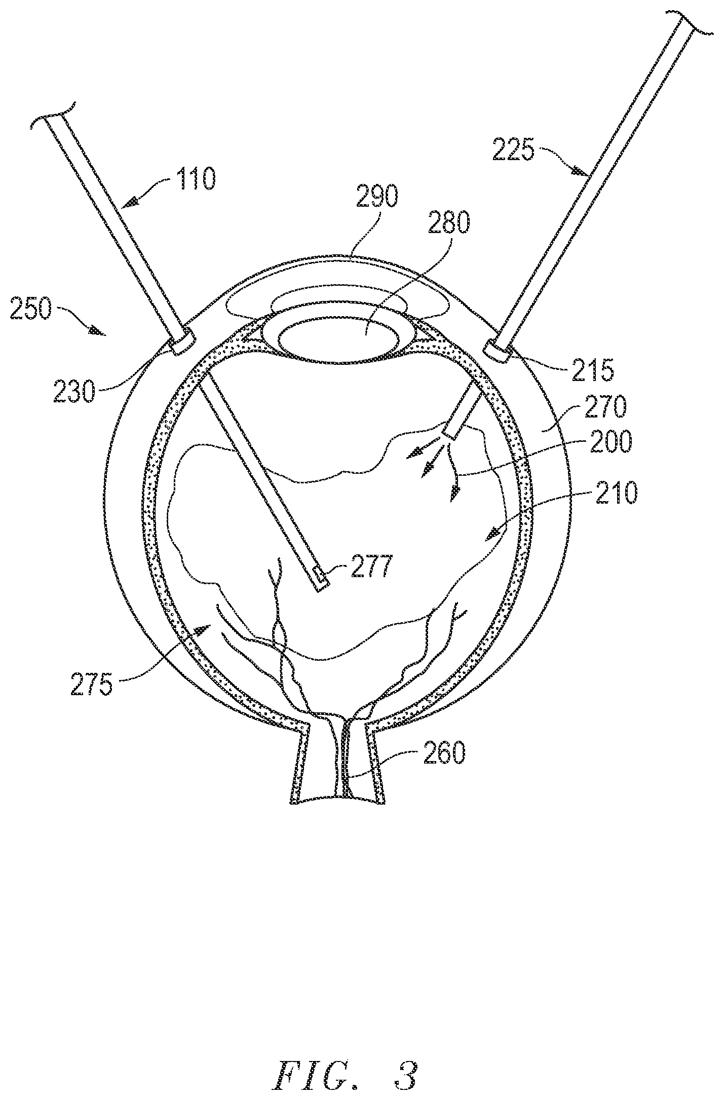 Patent US12311098 Figure 3 – Vacuum oscillation prevention in a venturi surgical system