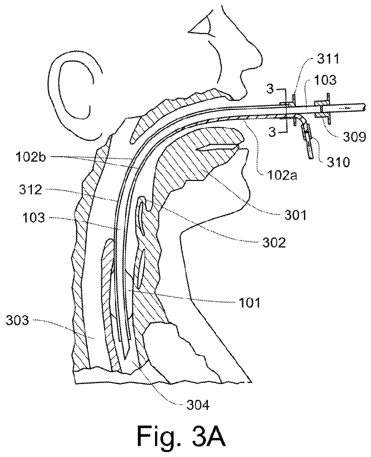 Patent US12311102 Figure 3 – Lung ventilator system and method of ventilating lungs in breathing and non-breathing patients