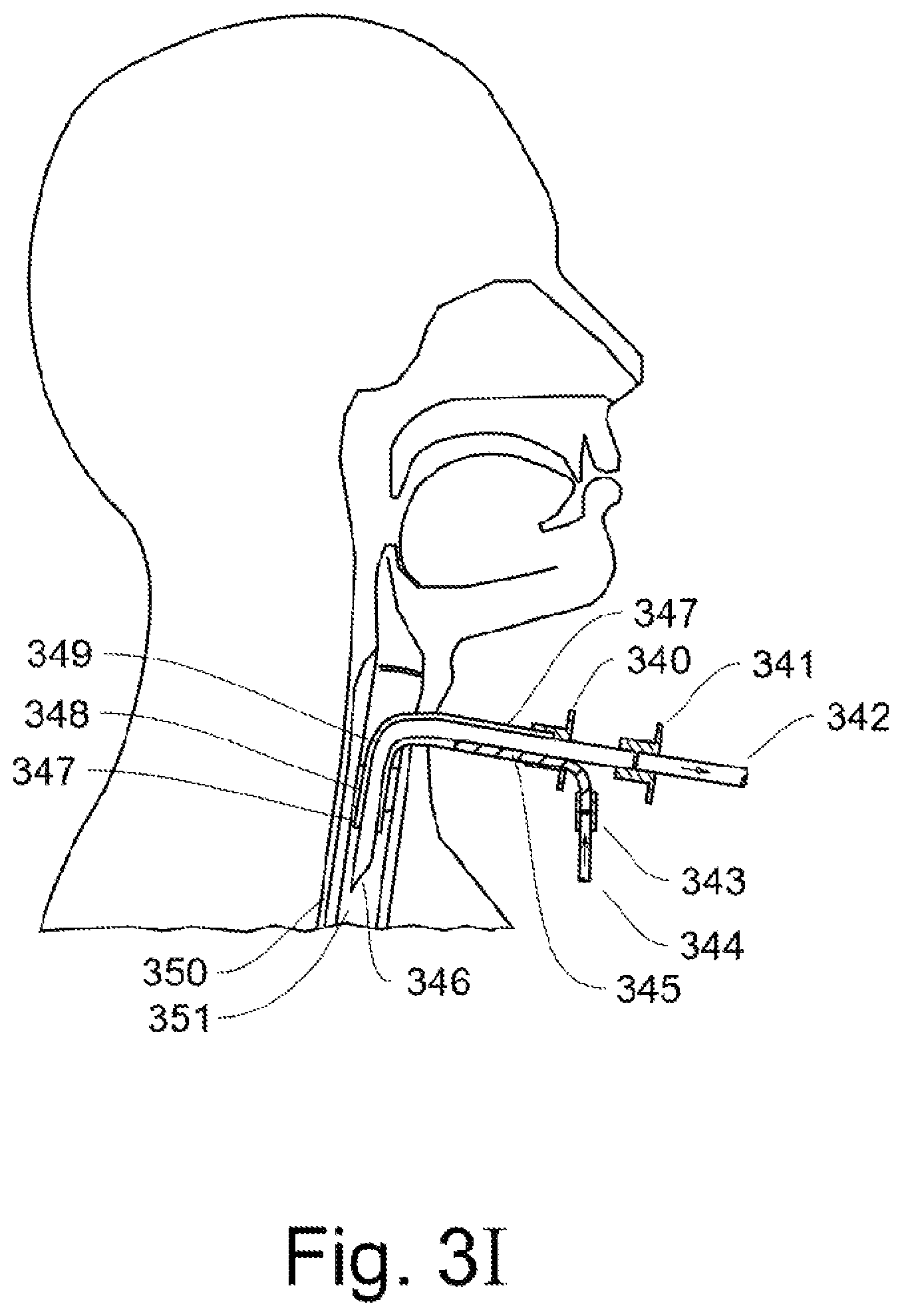 Patent US12311102 Figure 6 – Lung ventilator system and method of ventilating lungs in breathing and non-breathing patients
