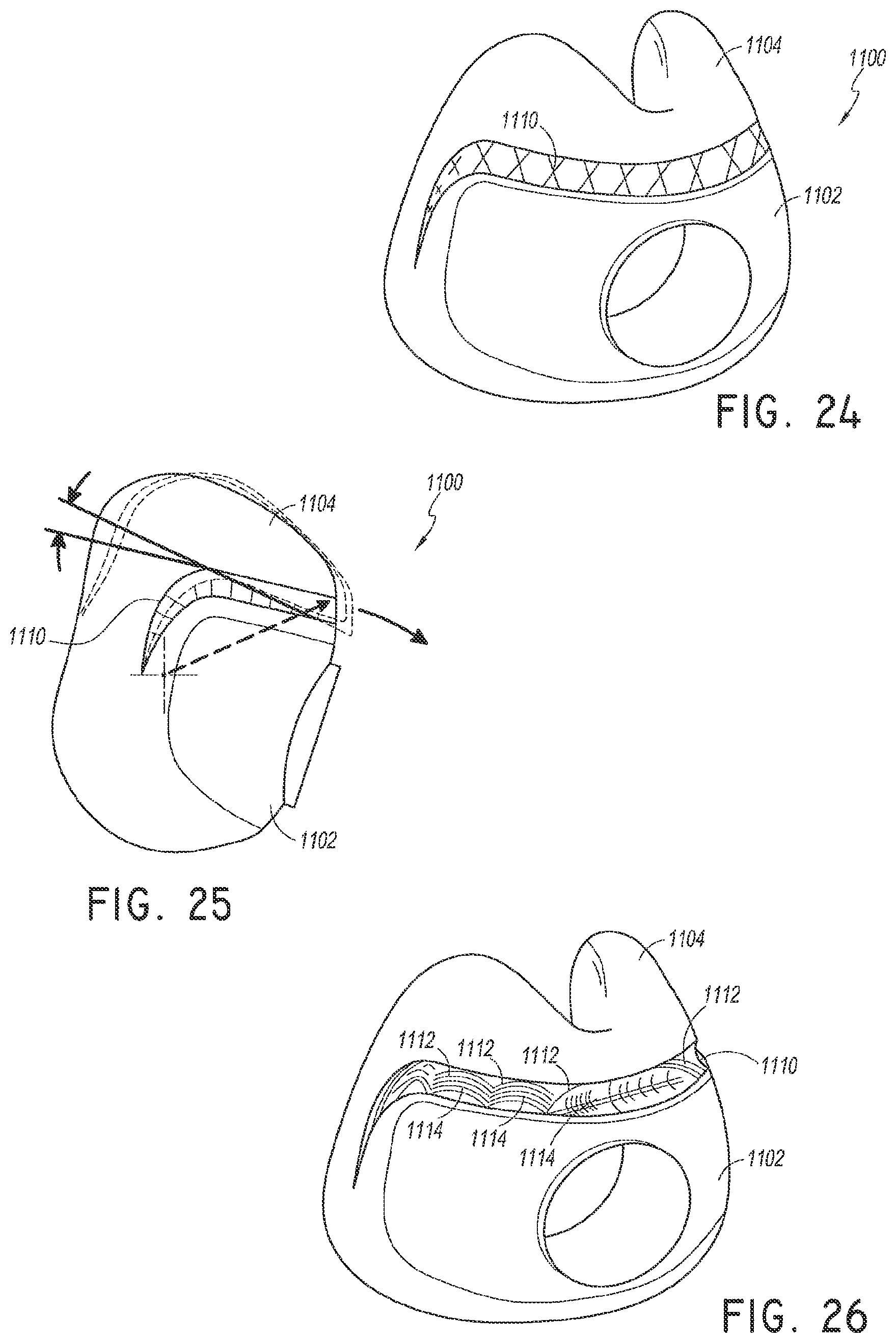 Patent US12311107 Figure 12 – Seal for a patient interface, interface assemblies and aspects thereof
