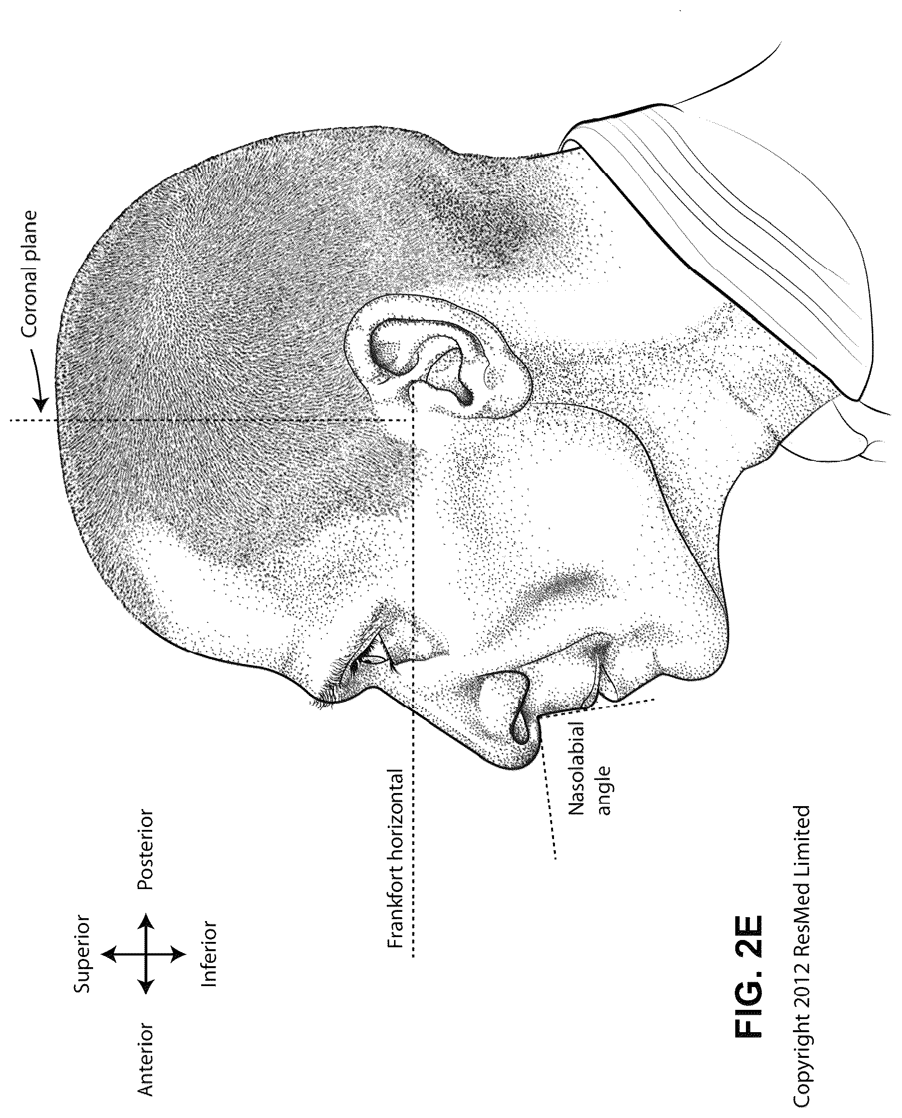 Patent US12311108 Figure 8 – Conduit headgear connector for patient interface
