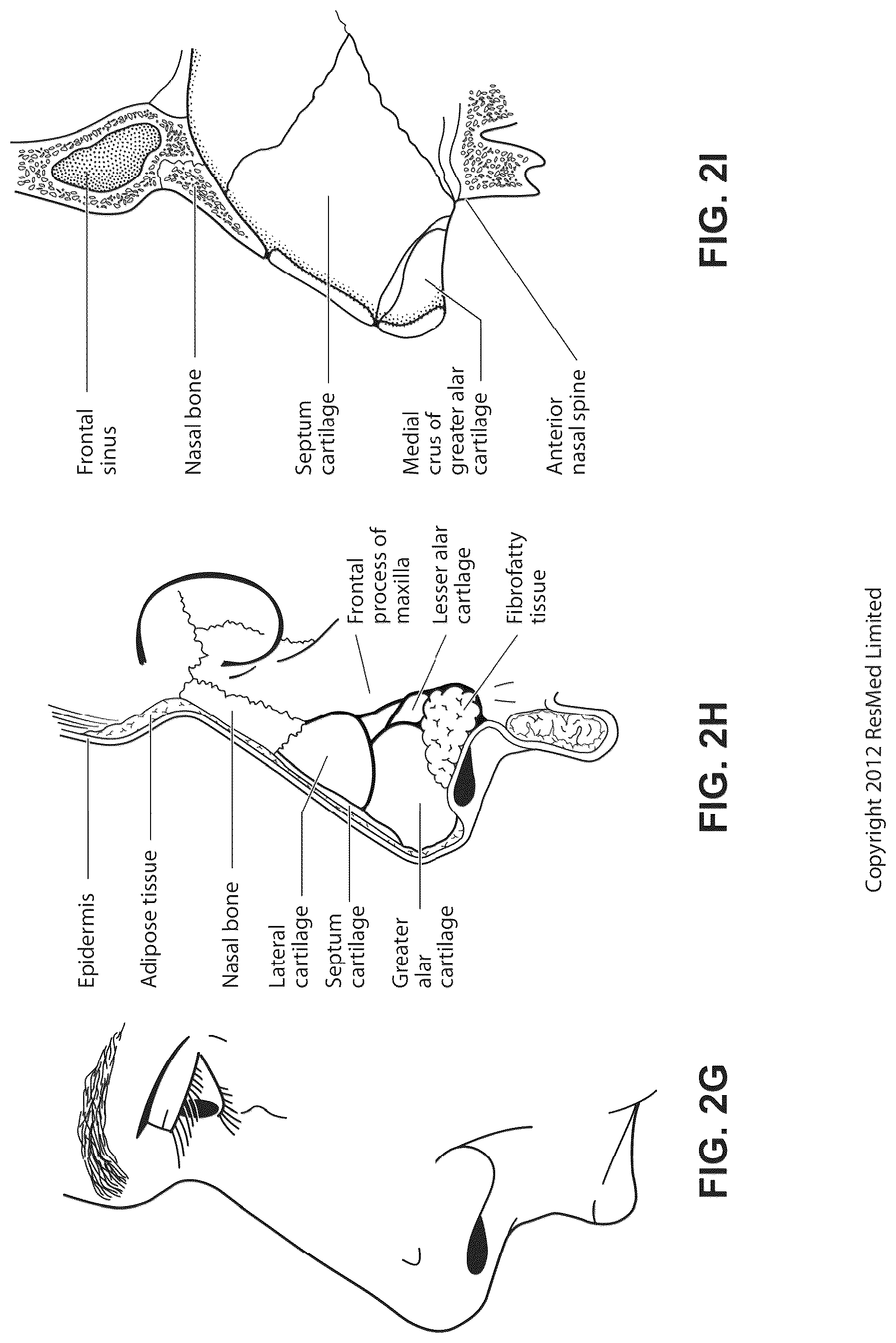 Patent US12311108 Figure 10 – Conduit headgear connector for patient interface