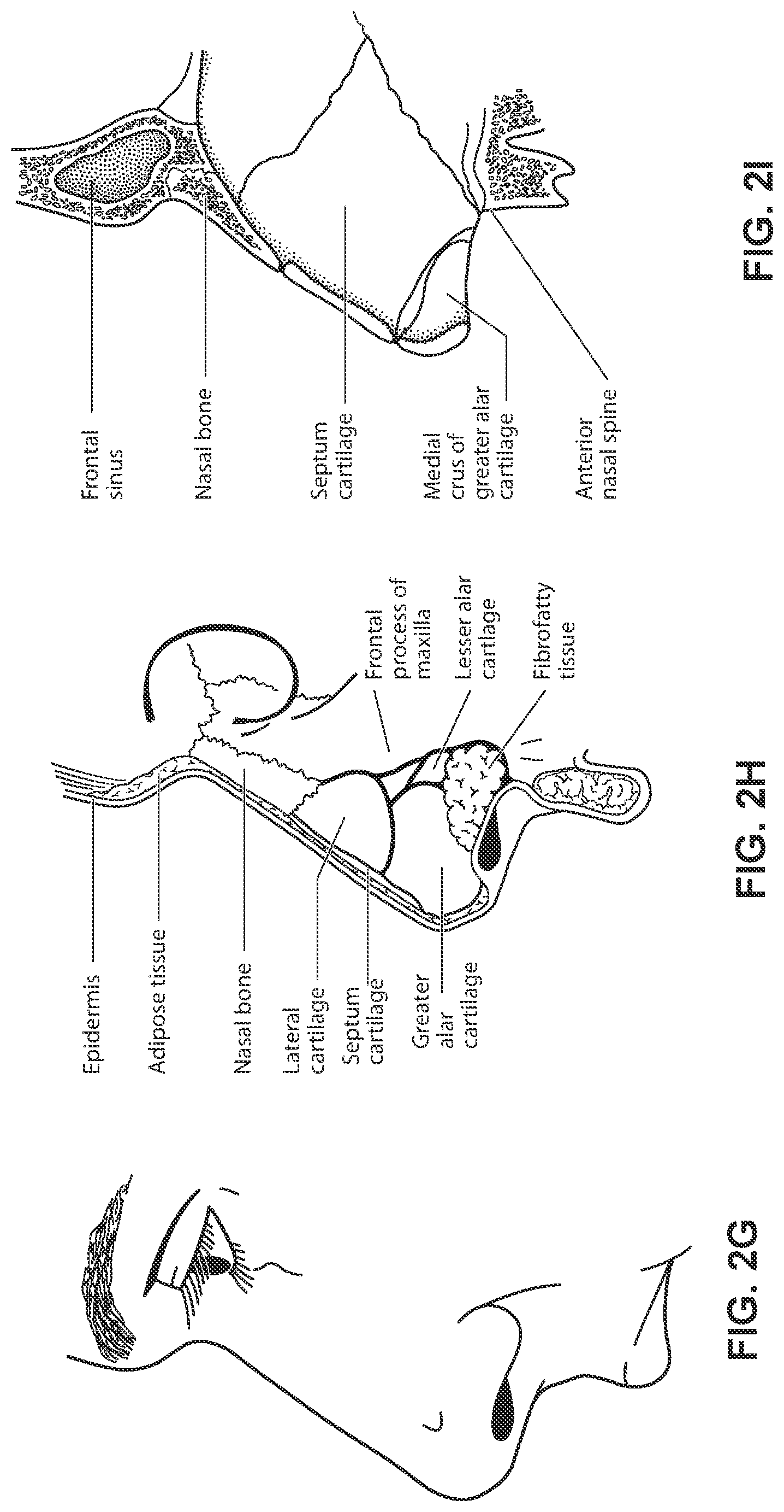 Patent US12311111 Figure 10 – Vent adaptor for a respiratory therapy system