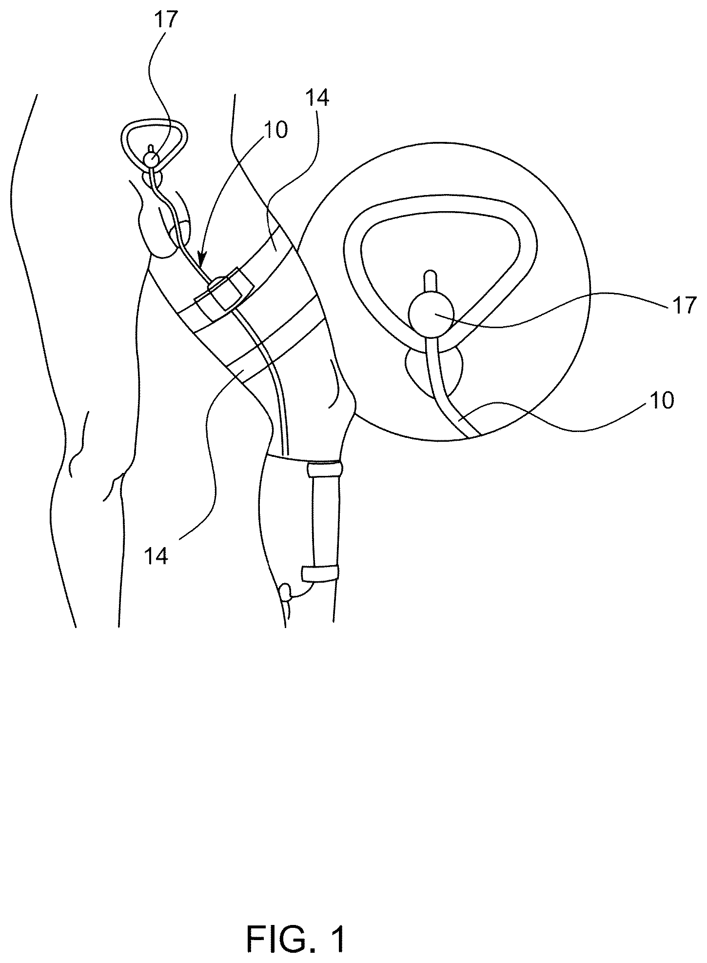 Patent US12311118 Figure 1 – Body fluid movement system