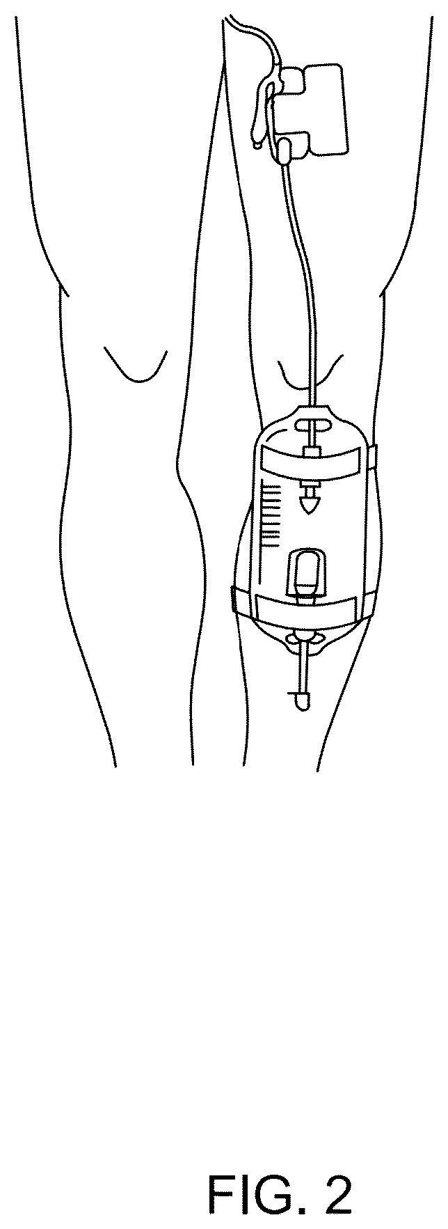 Patent US12311118 Figure 2 – Body fluid movement system