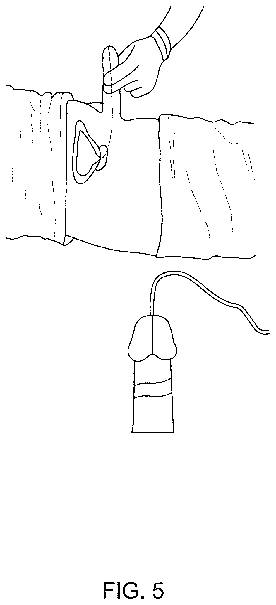 Patent US12311118 Figure 5 – Body fluid movement system