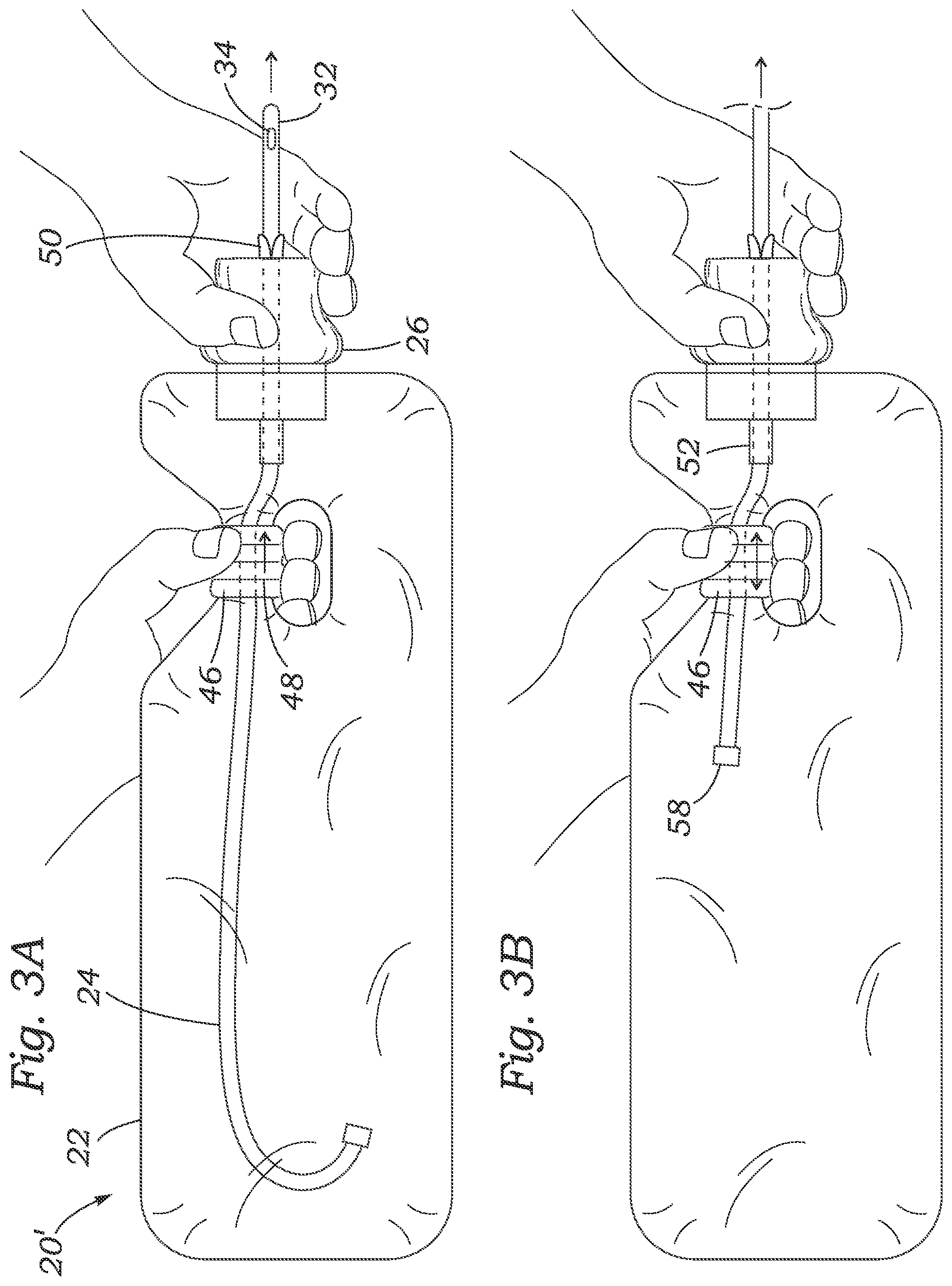 Patent US12311119 Figure 3 – Methods of urging a catheter from a closed urinary catheter system