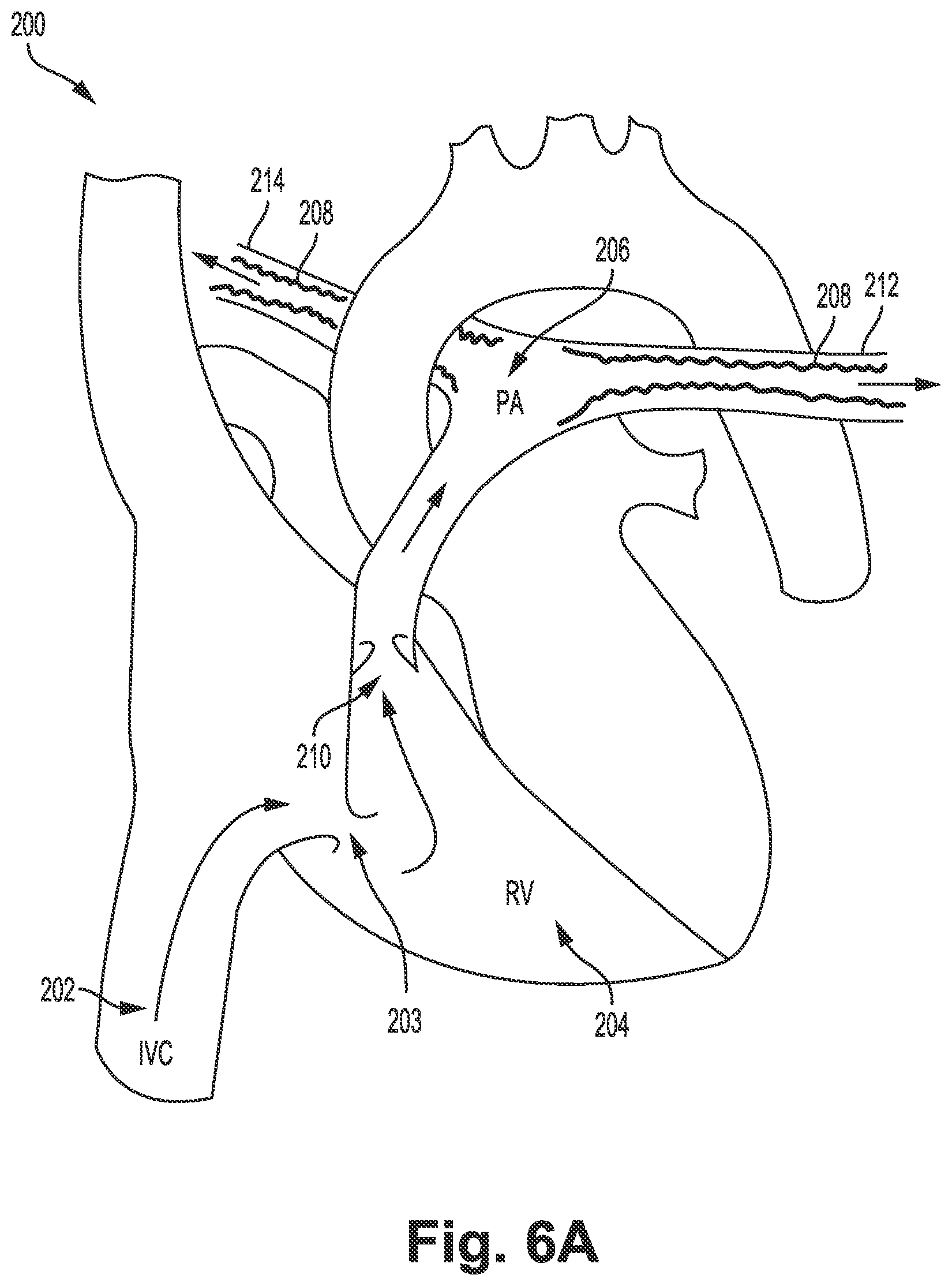 Patent US12311121 Figure 7 – Bi-lateral catheter system and methods for use