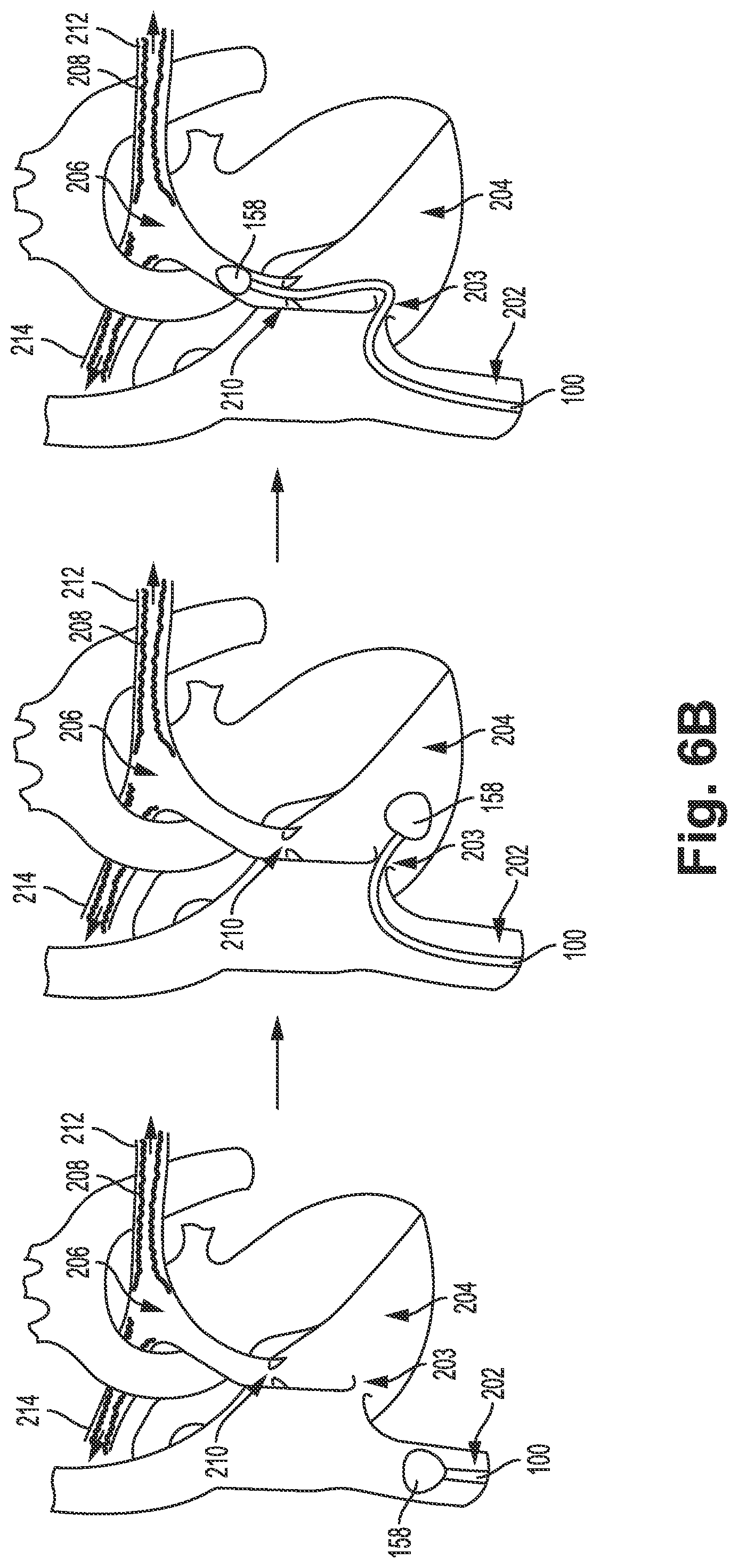 Patent US12311121 Figure 8 – Bi-lateral catheter system and methods for use