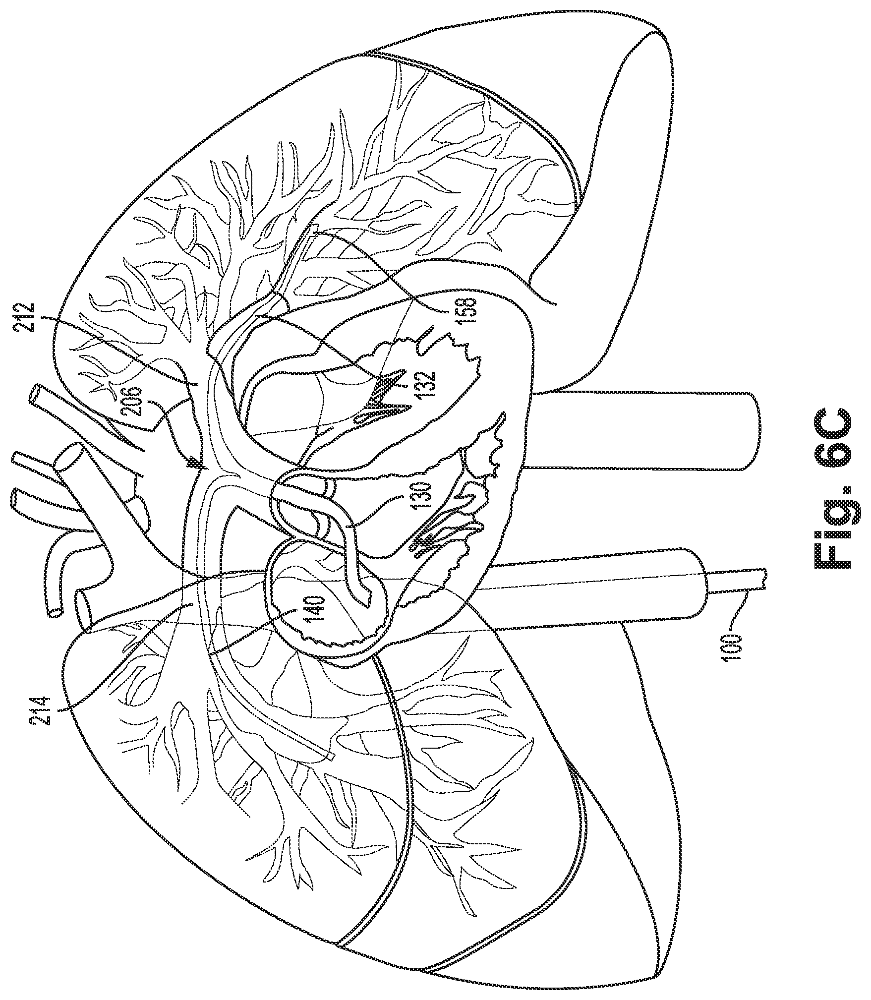 Patent US12311121 Figure 9 – Bi-lateral catheter system and methods for use
