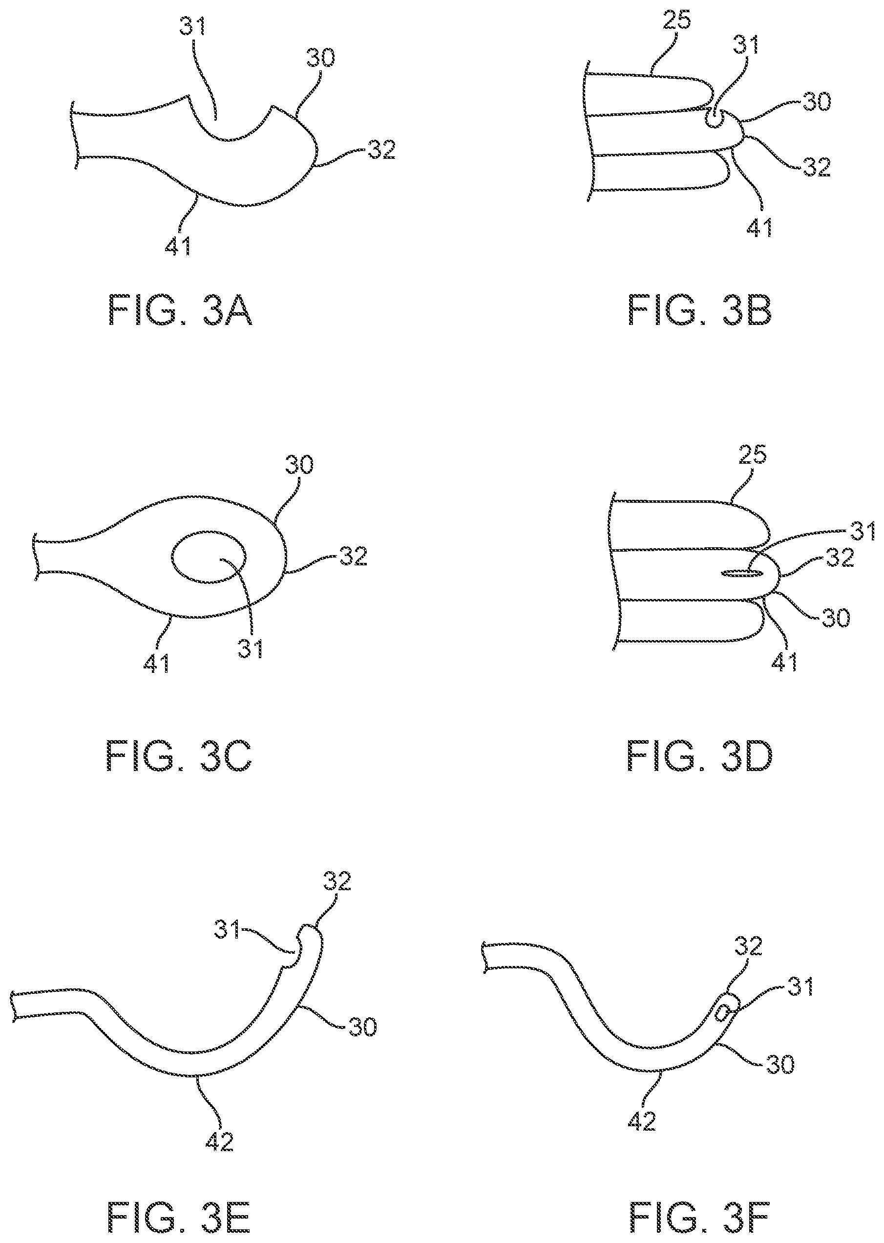 Patent US12311123 Figure 5 – Apparatus and method for everting catheter for uterine access for biopsy and cytology