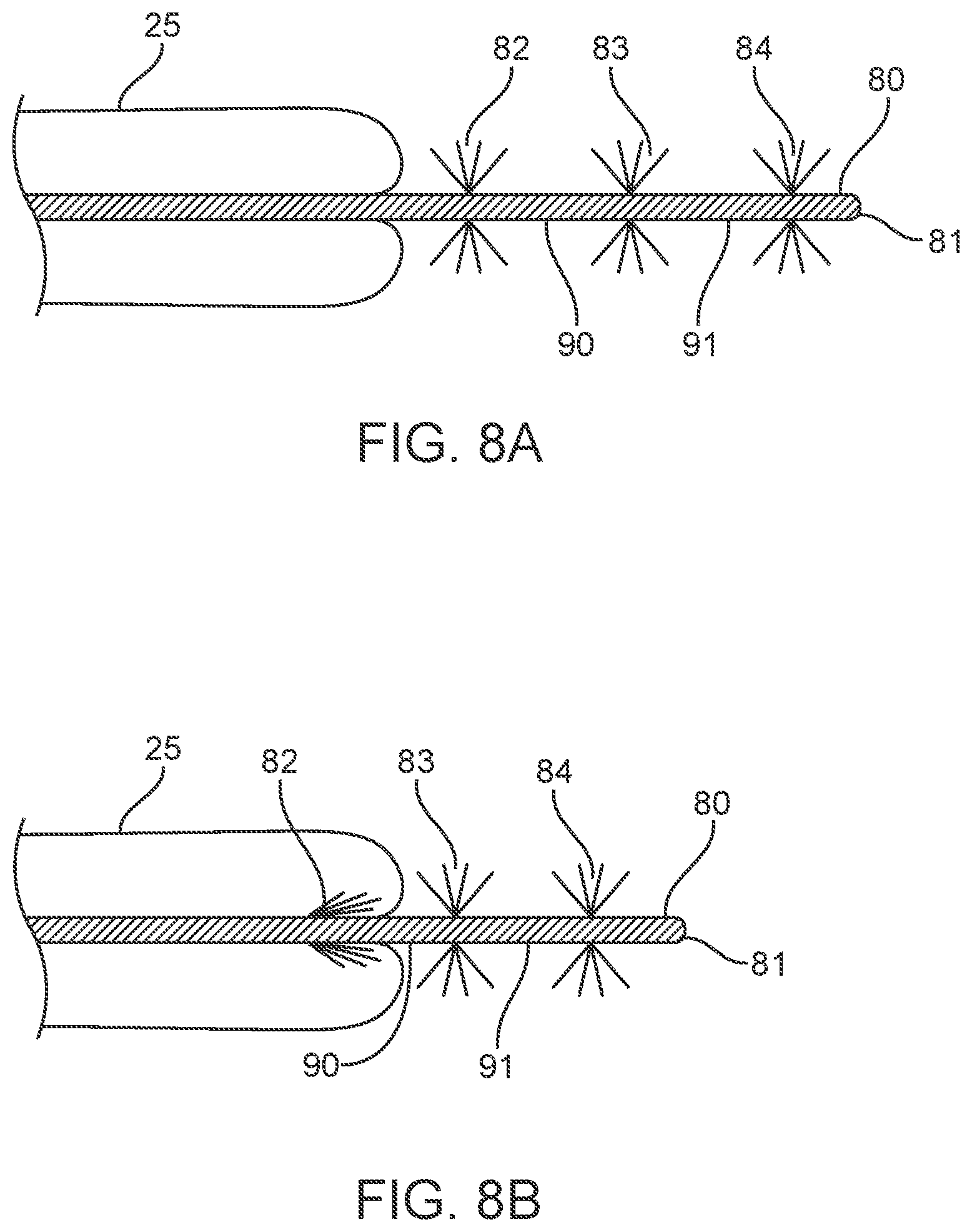 Patent US12311123 Figure 10 – Apparatus and method for everting catheter for uterine access for biopsy and cytology