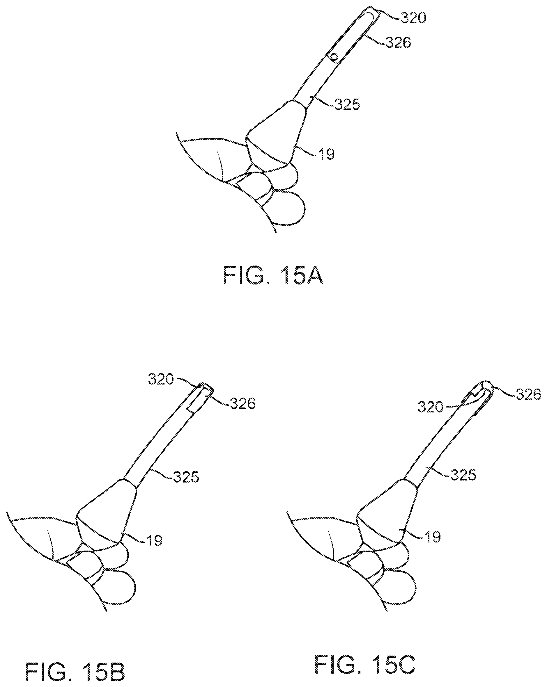 Patent US12311123 Figure 18 – Apparatus and method for everting catheter for uterine access for biopsy and cytology