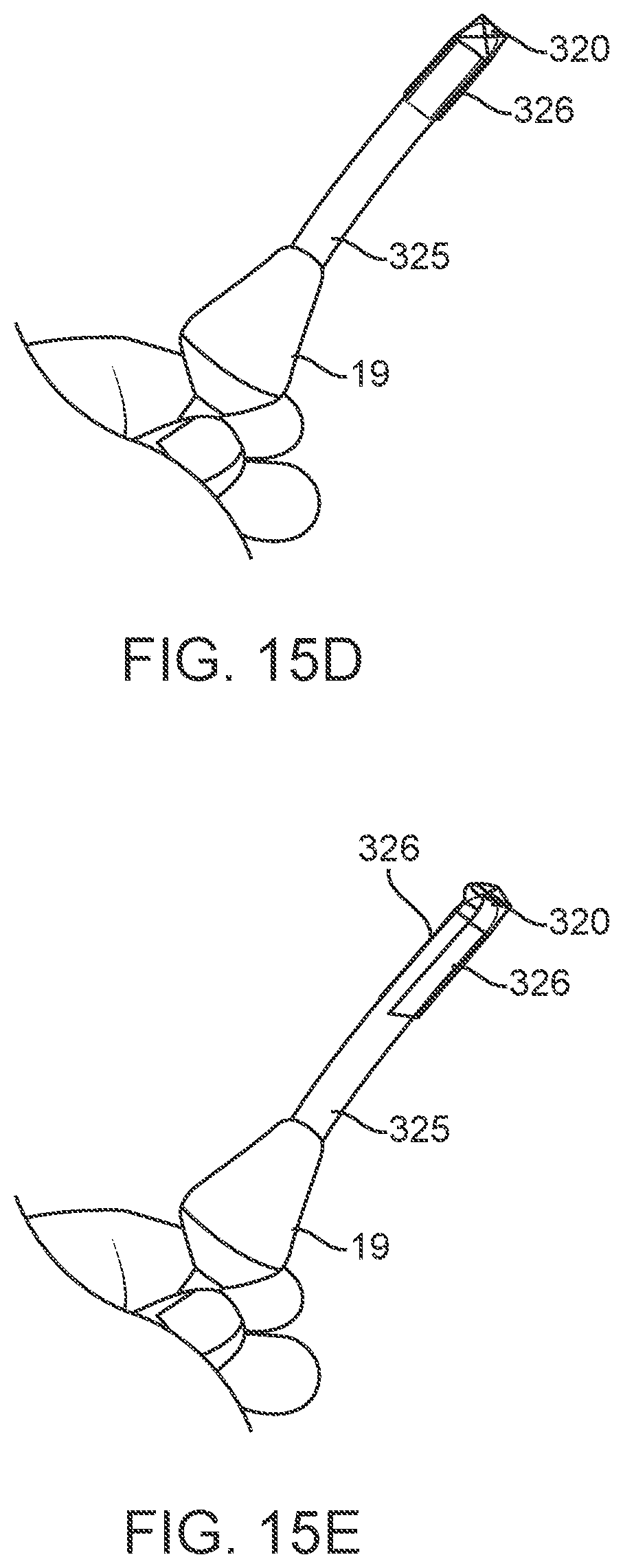Patent US12311123 Figure 19 – Apparatus and method for everting catheter for uterine access for biopsy and cytology