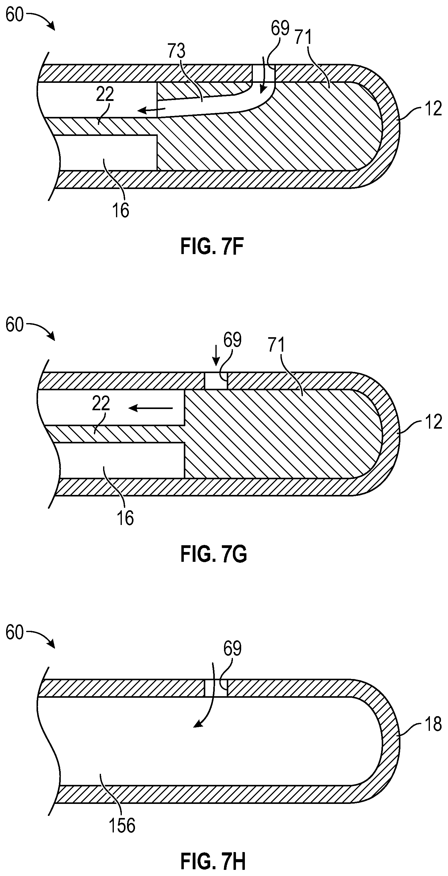 Patent US12311131 Figure 13 – Tubular instrument to reduce vein trauma and related devices and methods