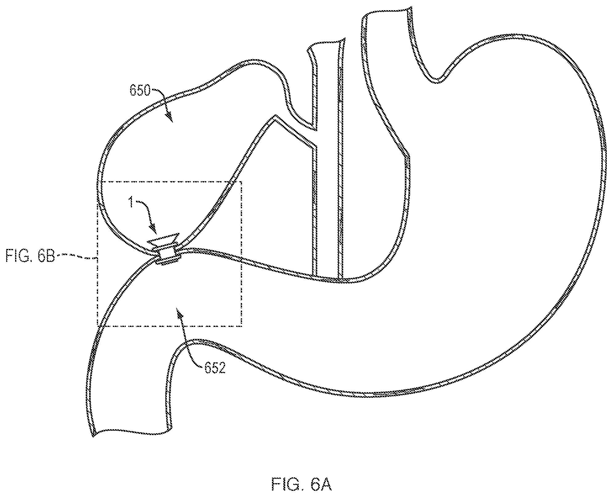Patent US12311133 Figure 4 – Anastomotic drainage stent
