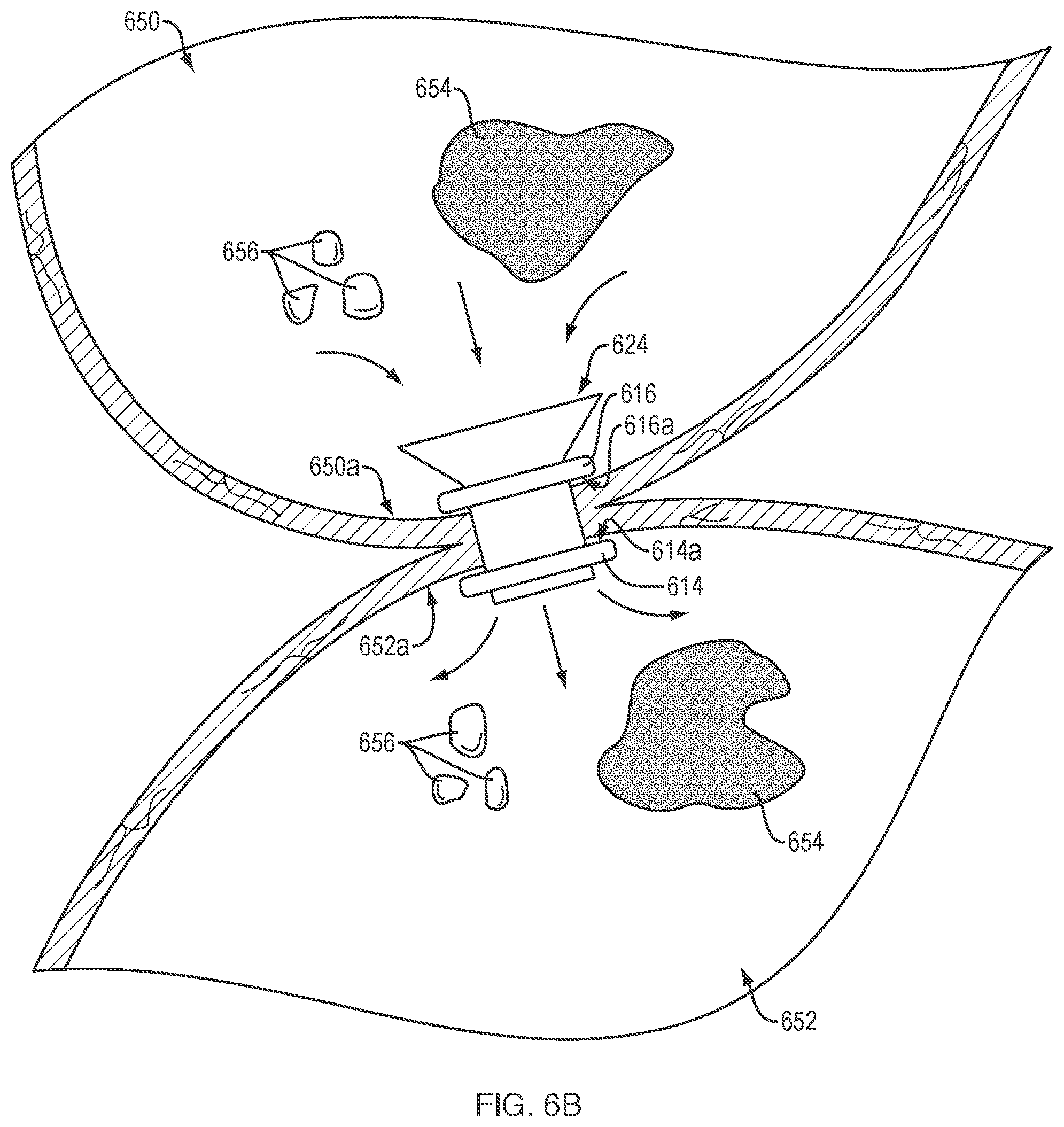 Patent US12311133 Figure 5 – Anastomotic drainage stent