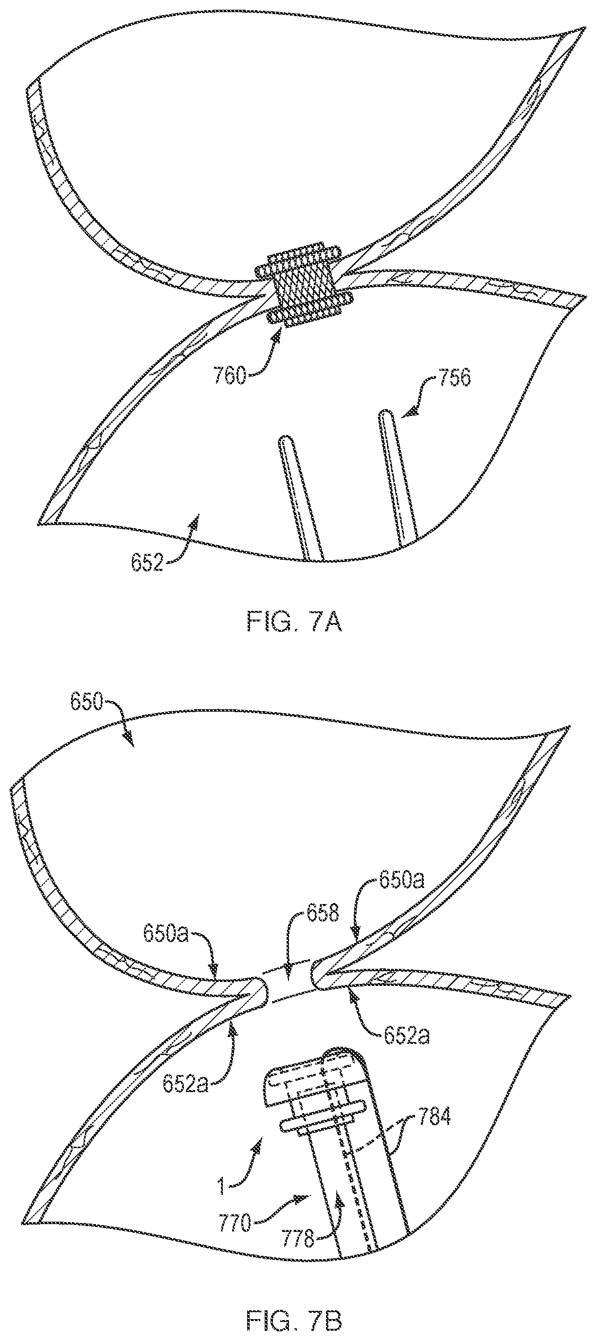 Patent US12311133 Figure 6 – Anastomotic drainage stent