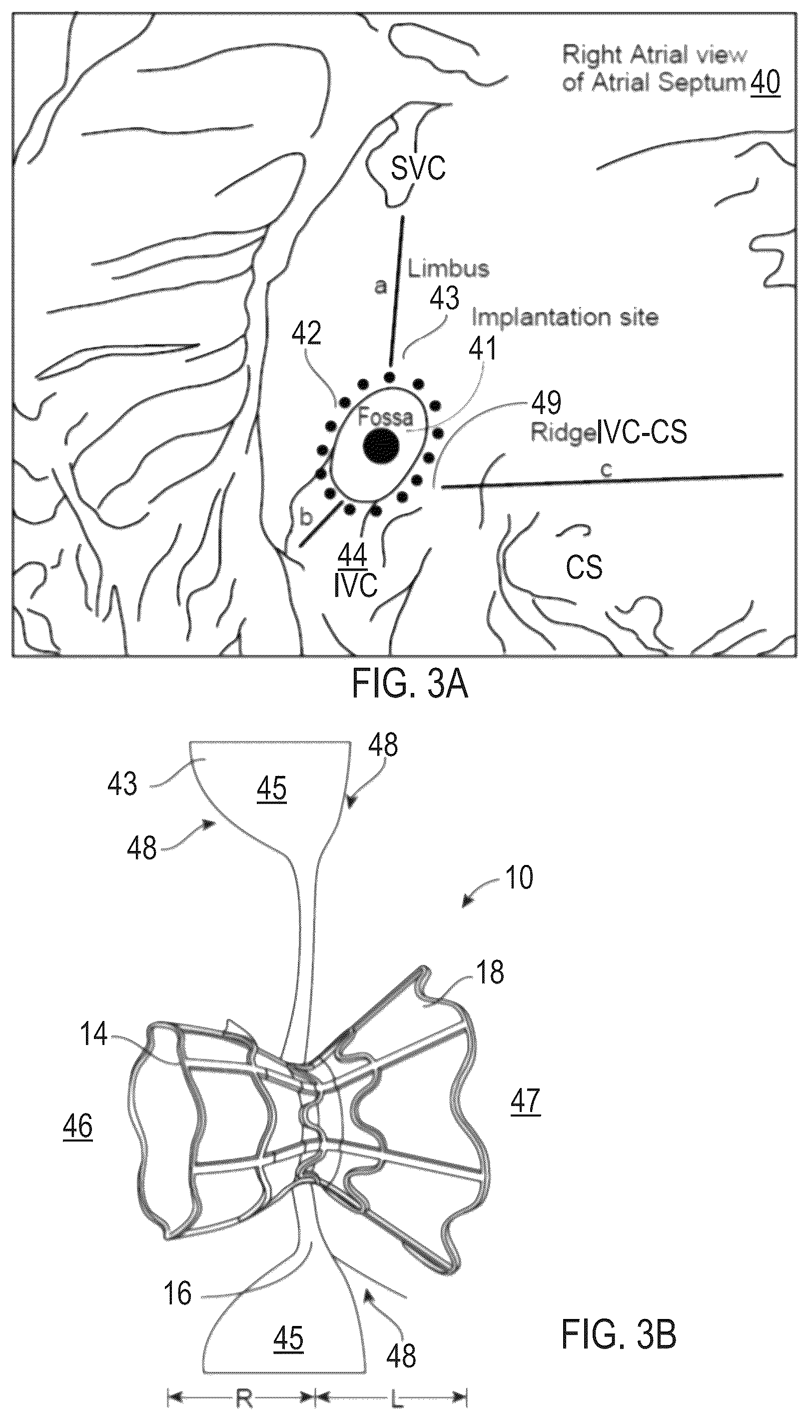 Patent US12311134 Figure 3 – Asymmetric shunt for redistributing atrial blood volume